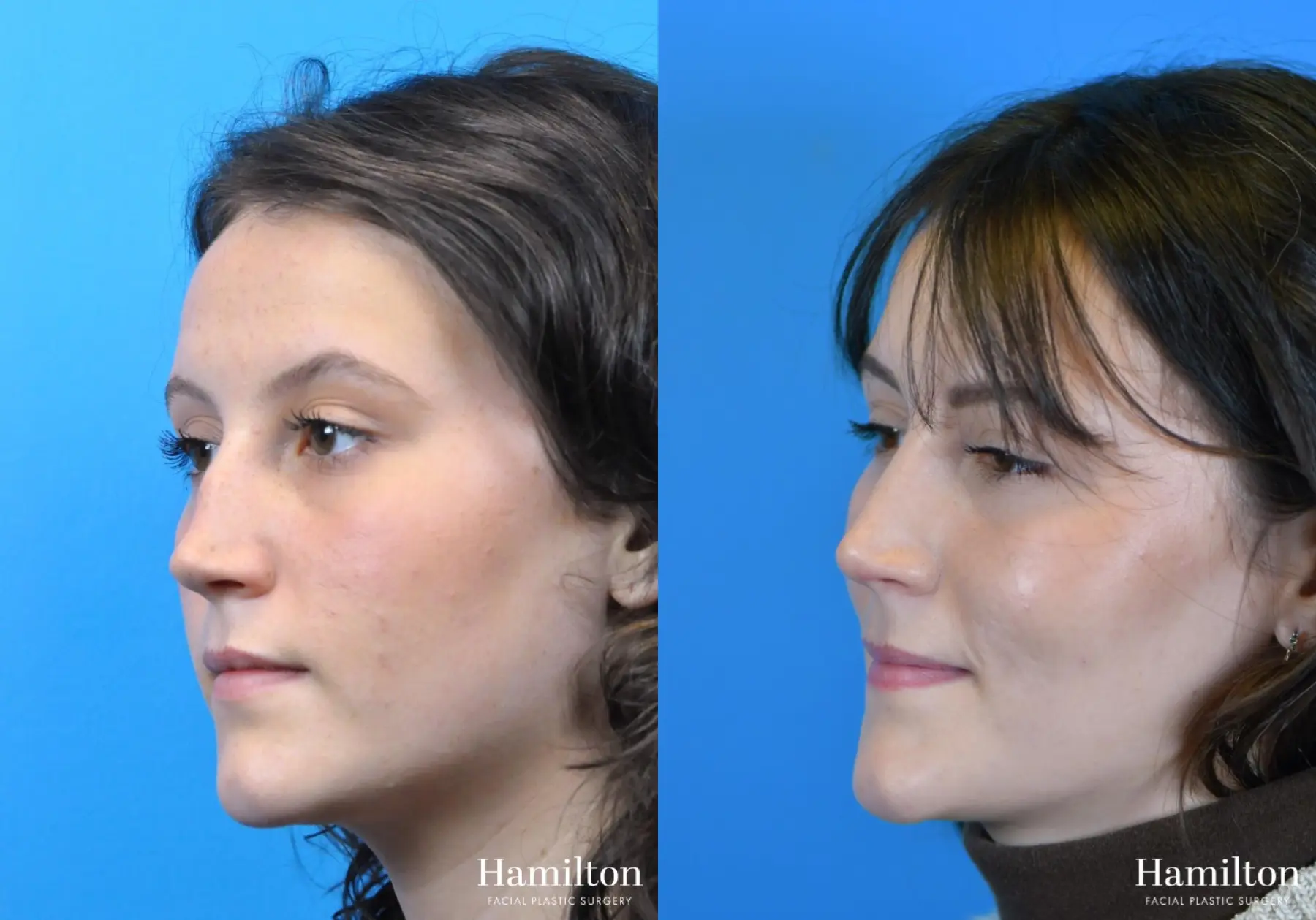 Rhinoplasty: Patient 15 - Before and After 4