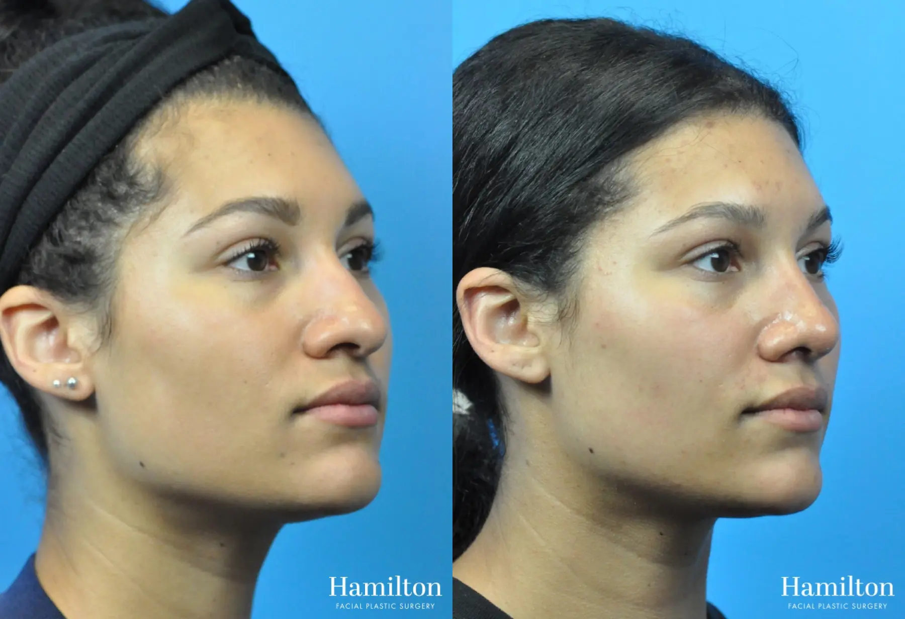 Rhinoplasty: Patient 43 - Before and After 5