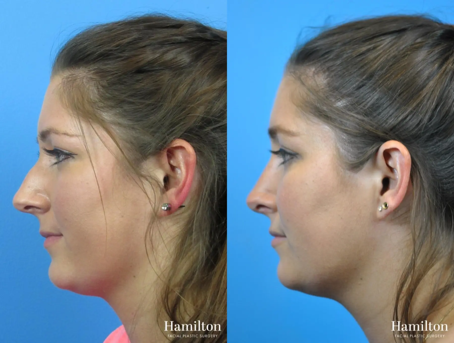 Rhinoplasty: Patient 32 - Before and After 1