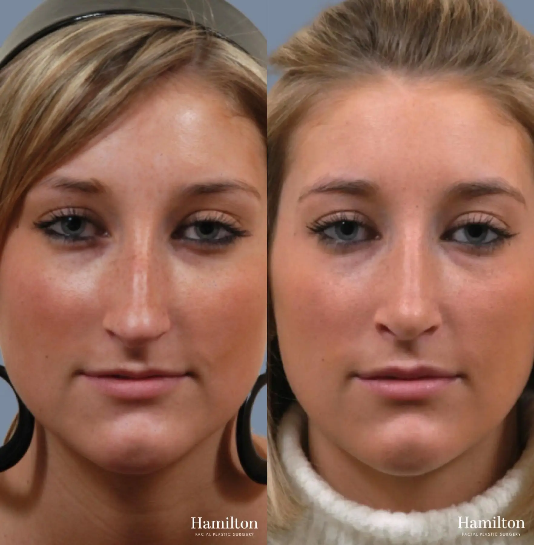 Rhinoplasty: Patient 7 - Before and After 5