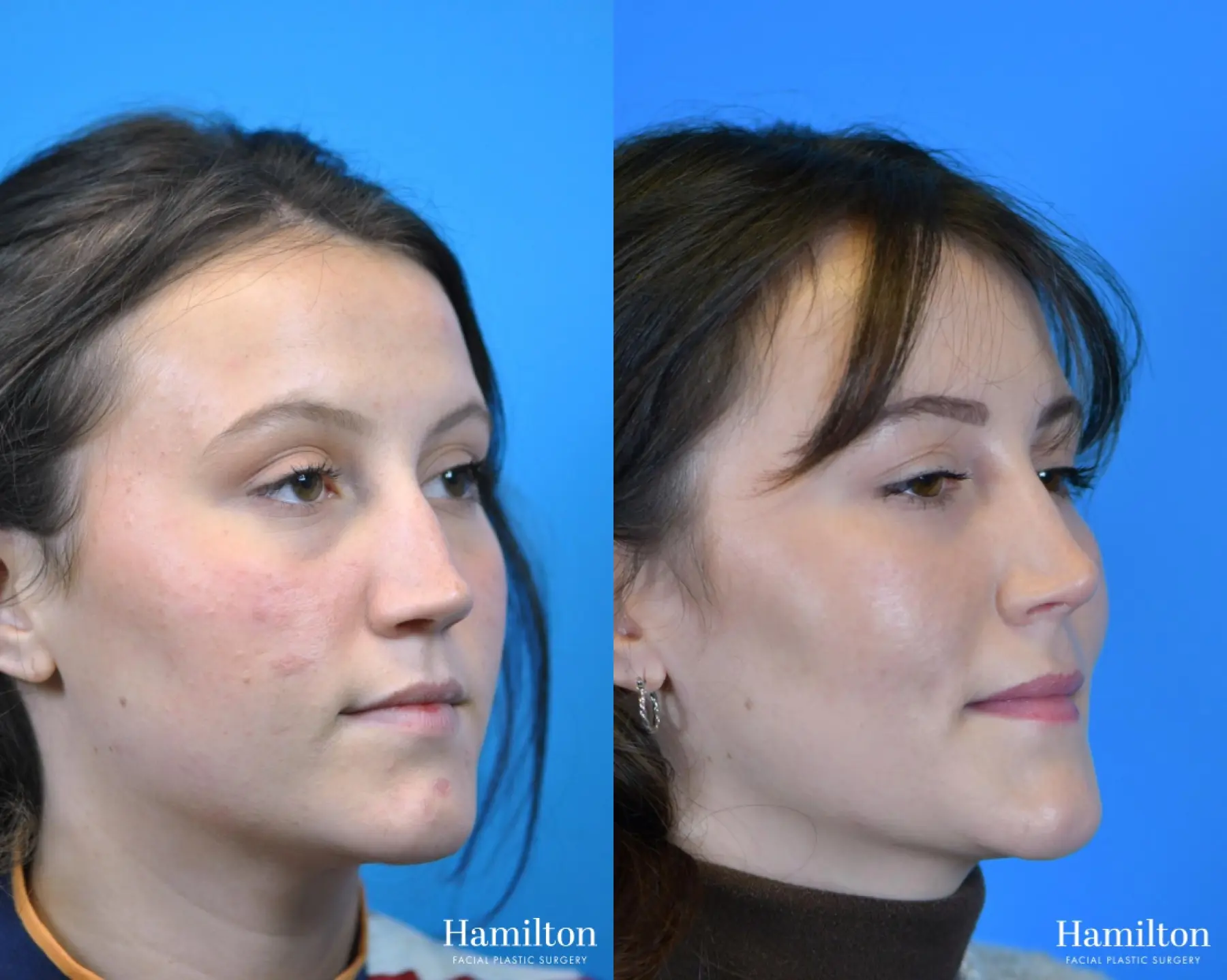 Rhinoplasty: Patient 15 - Before and After 2