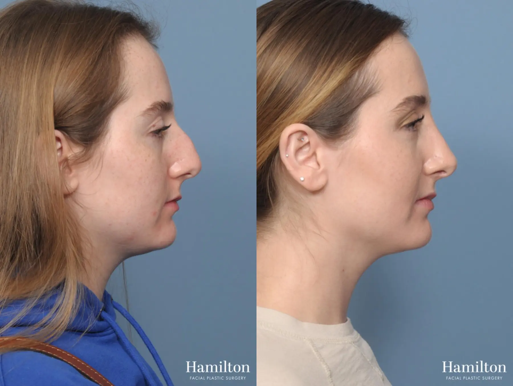 Rhinoplasty: Patient 1 - Before and After 4