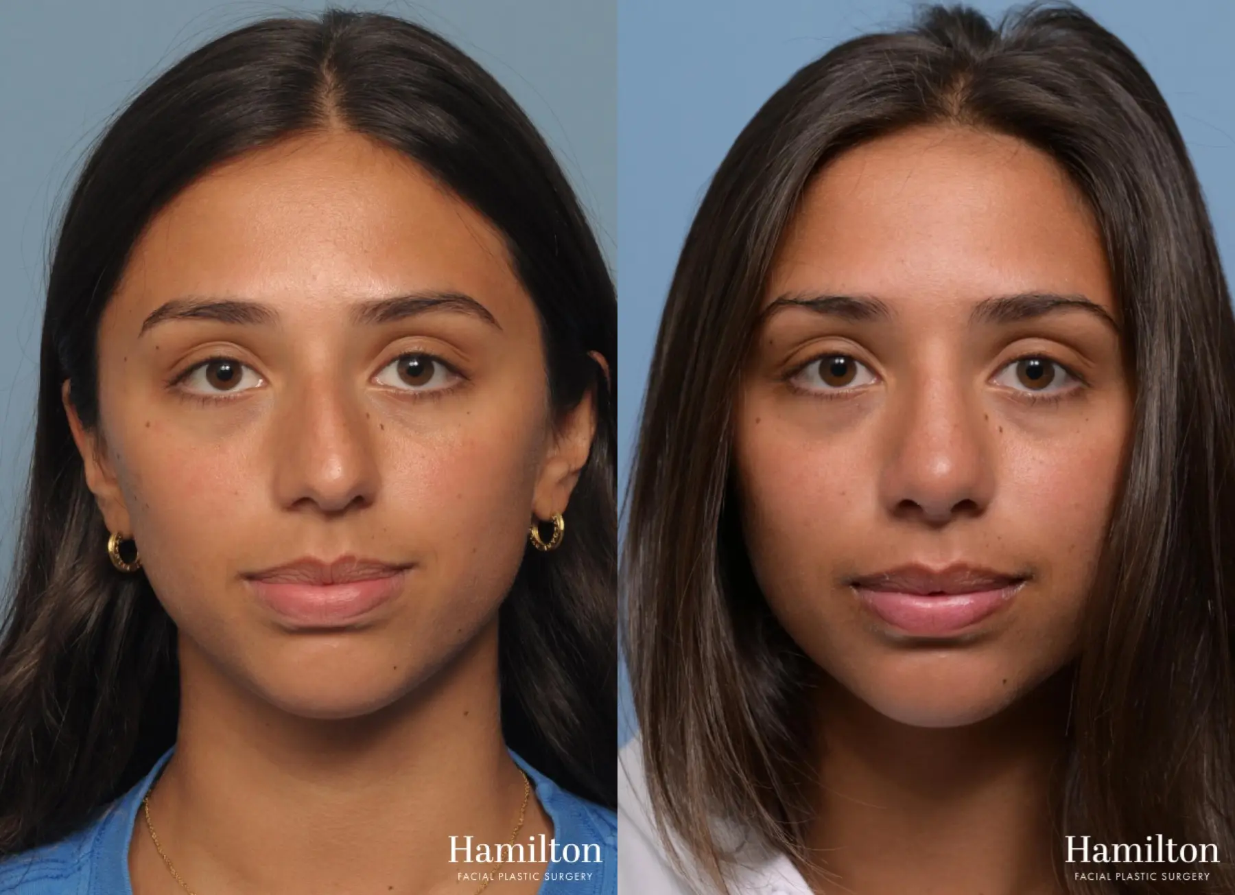 Rhinoplasty: Patient 4 - Before and After 5