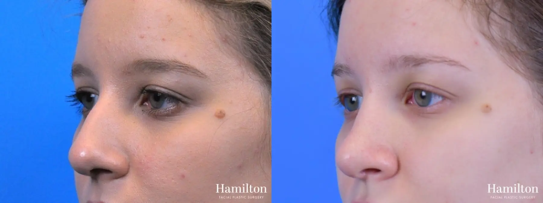 Rhinoplasty: Patient 18 - Before and After 4