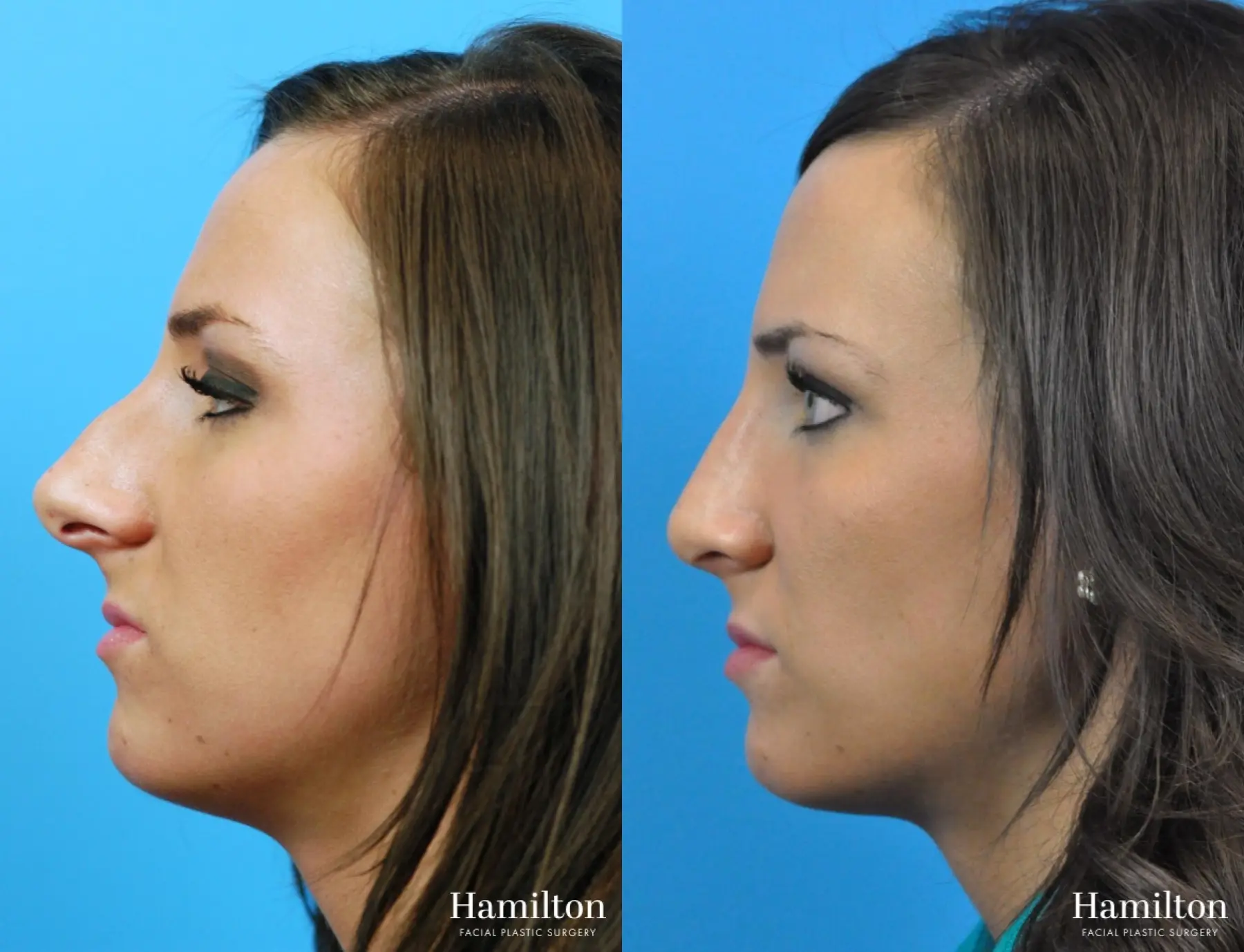 Rhinoplasty: Patient 24 - Before and After 2