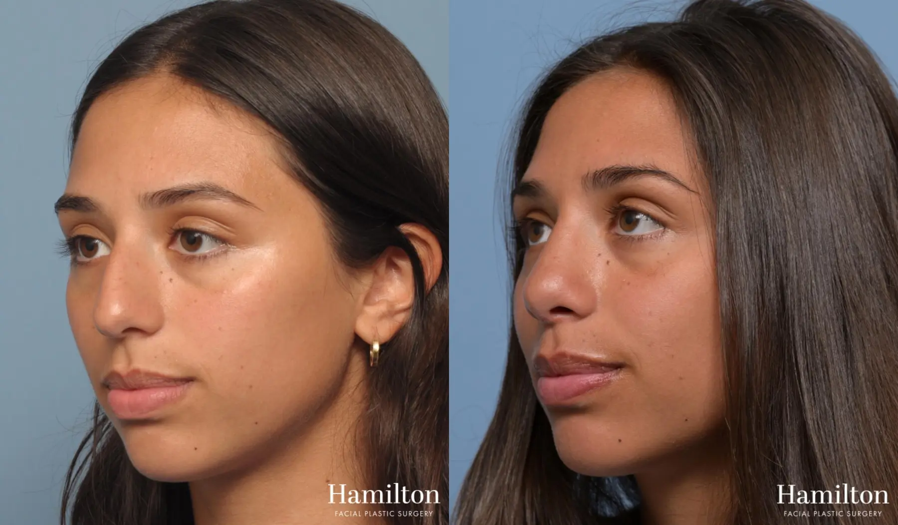 Rhinoplasty: Patient 4 - Before and After 3