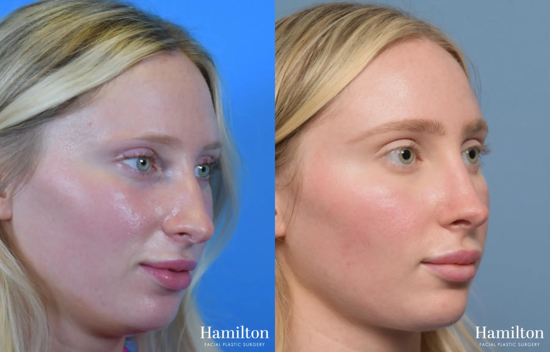 Rhinoplasty: Patient 3 - Before and After 2