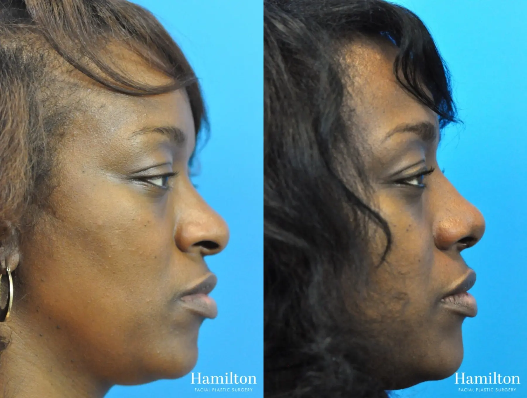 Rhinoplasty: Patient 25 - Before and After 2