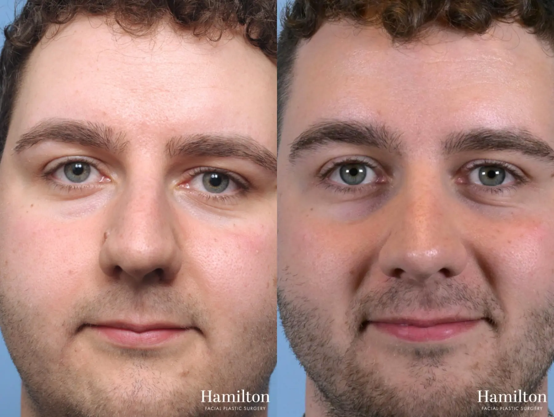 Rhinoplasty: Patient 9 - Before and After 5