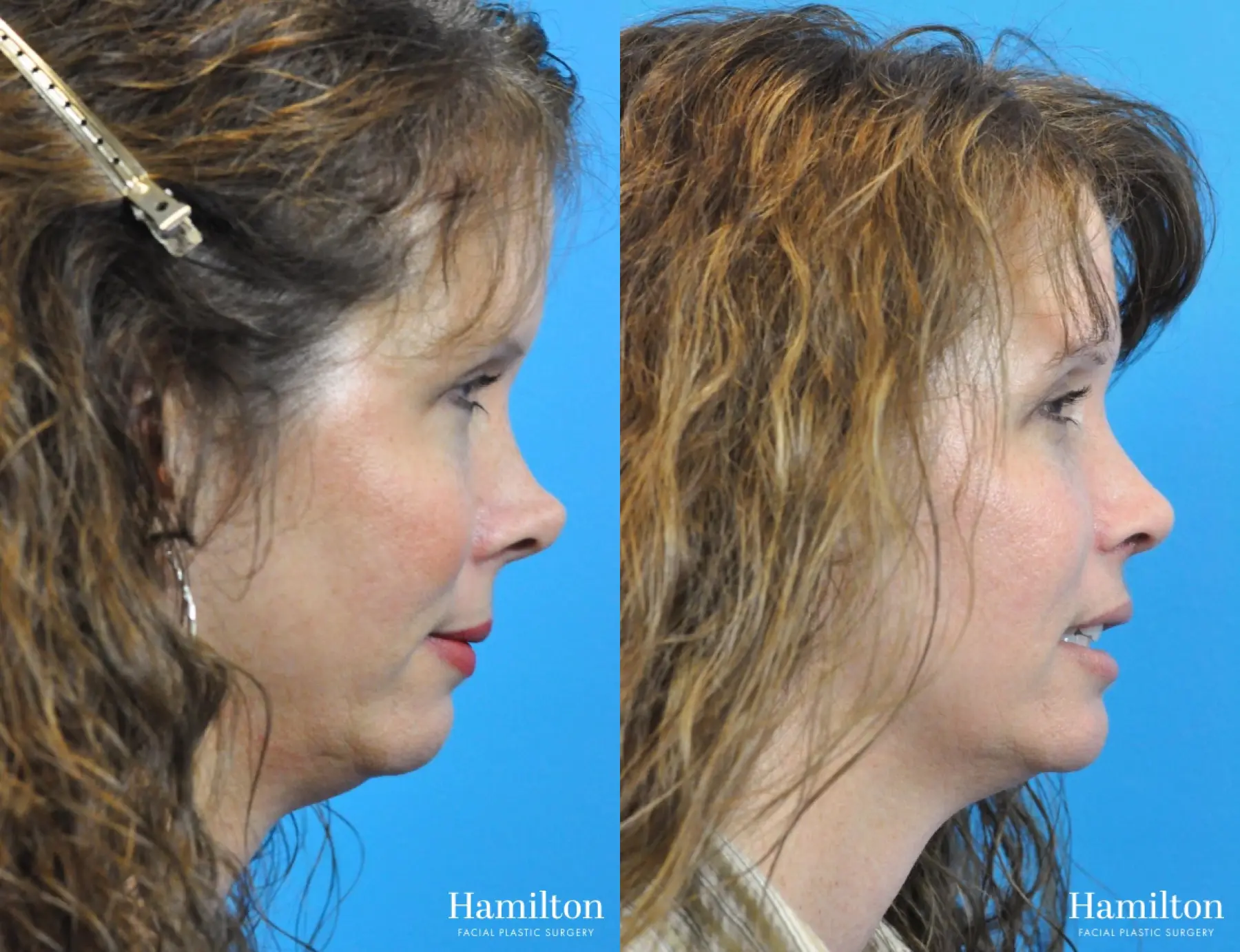 Rhinoplasty: Patient 24 - Before and After 5