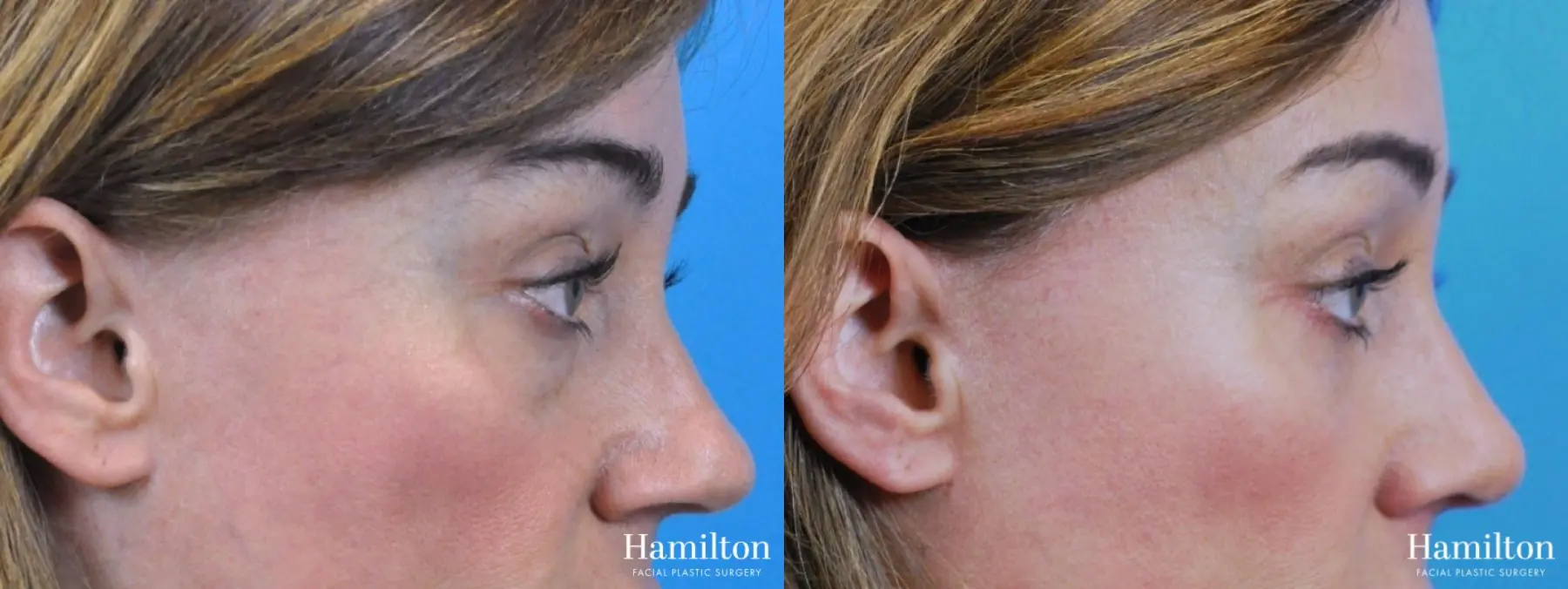 Rhinoplasty: Patient 33 - Before and After 4