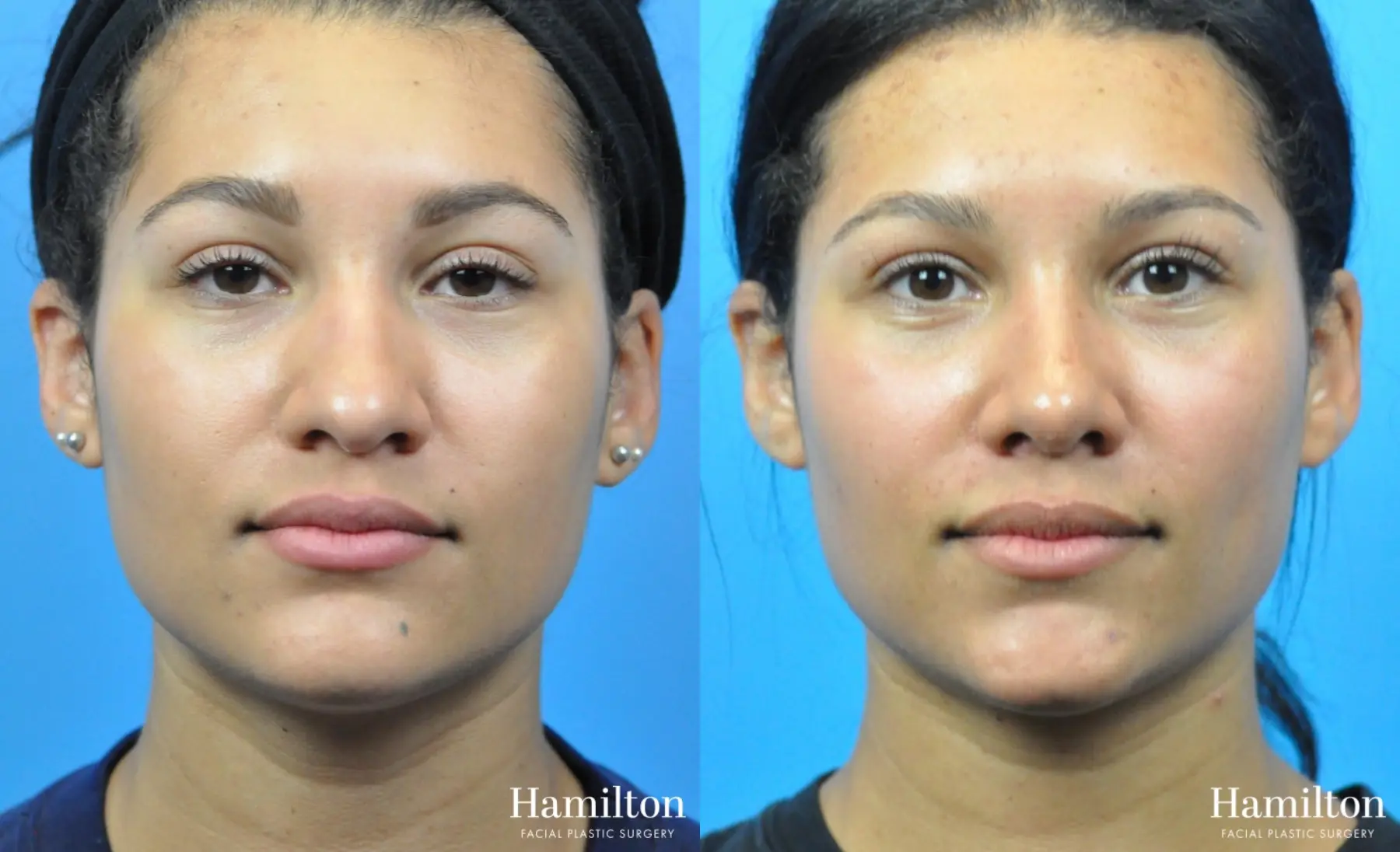 Rhinoplasty: Patient 43 - Before and After 1