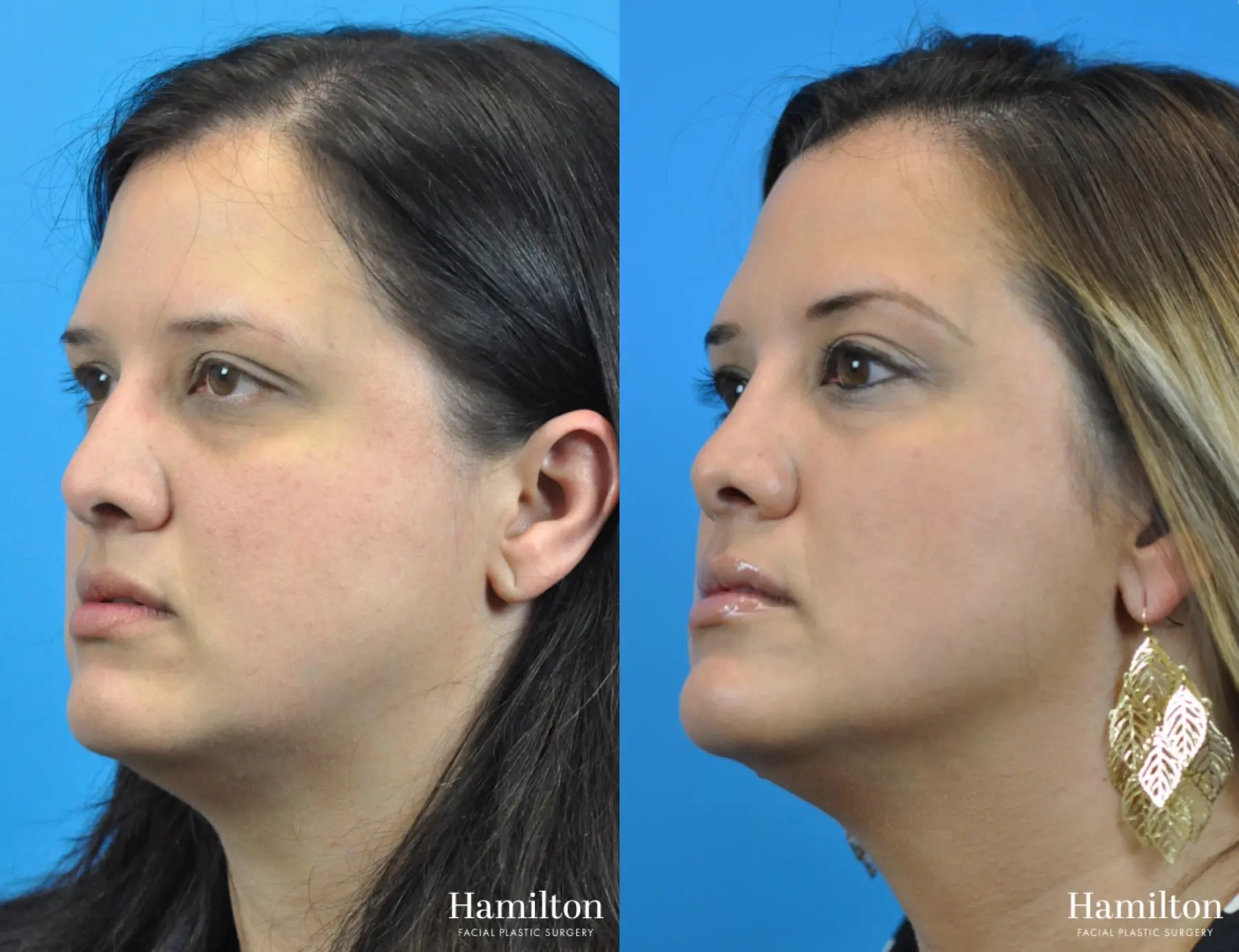 Rhinoplasty: Patient 36 - Before and After 4