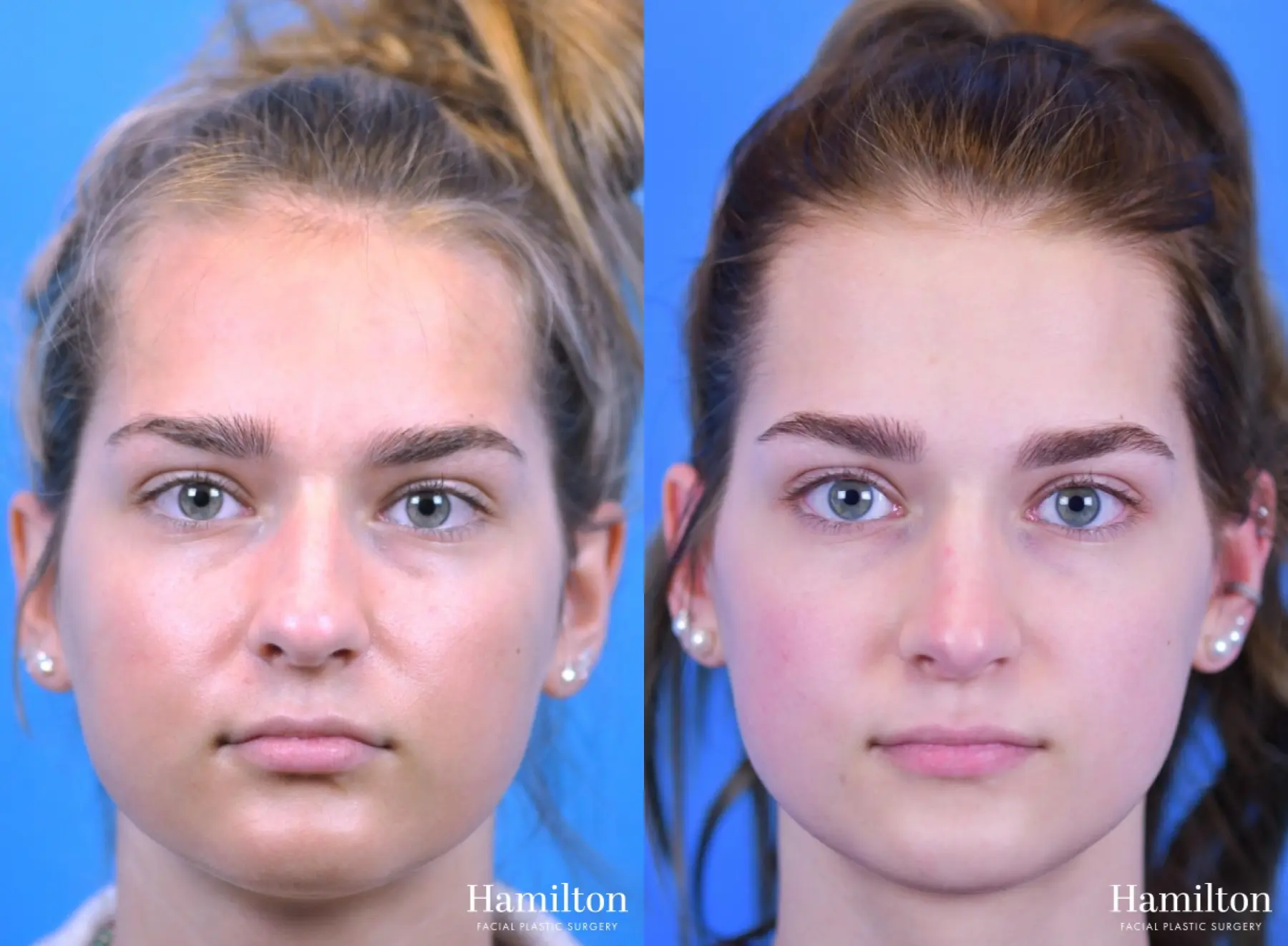 Rhinoplasty: Patient 11 - Before and After 5