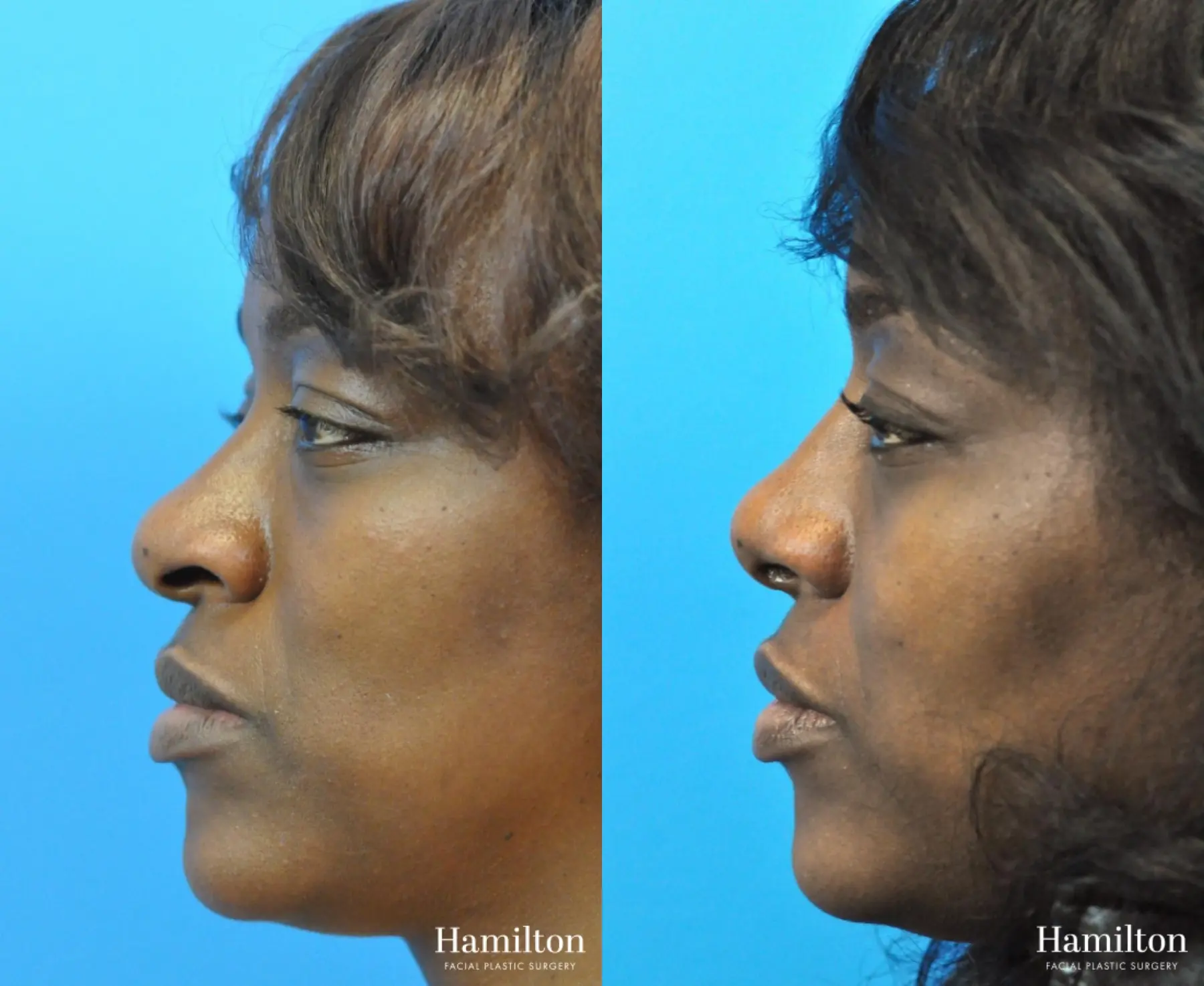 Rhinoplasty: Patient 25 - Before and After 1