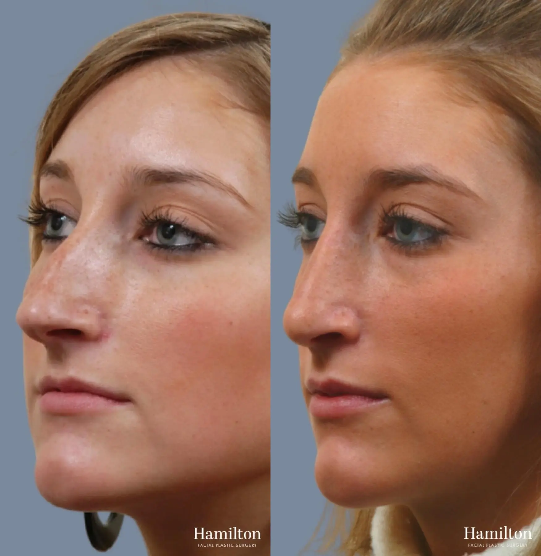 Rhinoplasty: Patient 7 - Before and After 2