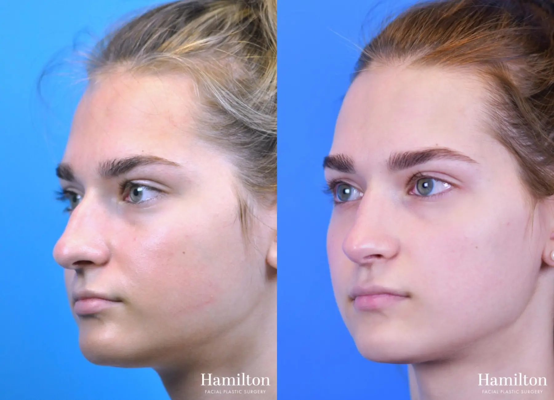 Rhinoplasty: Patient 11 - Before and After 4