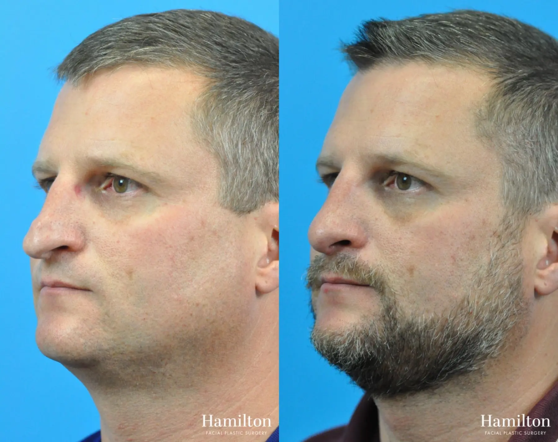 Rhinoplasty: Patient 27 - Before and After 3