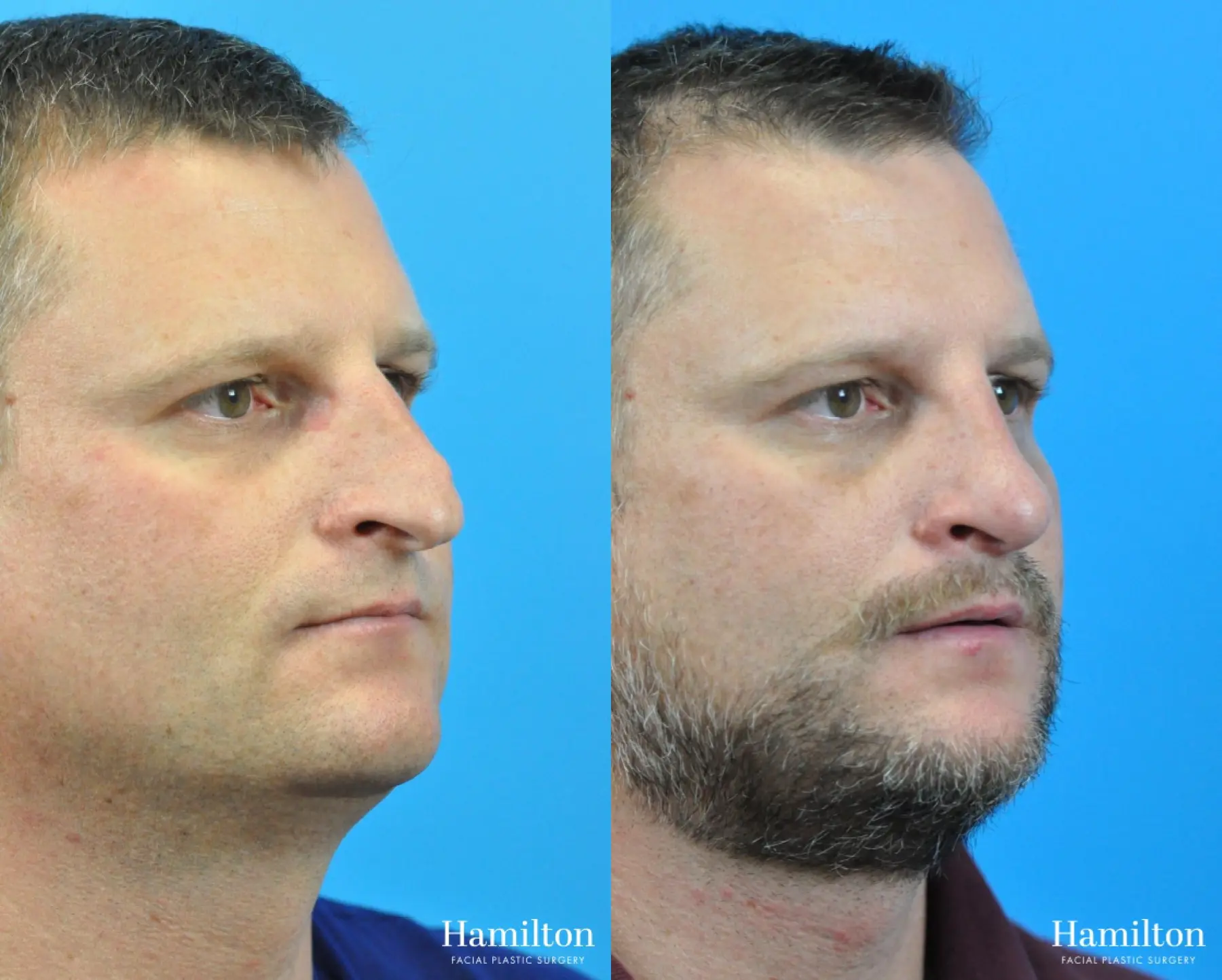 Rhinoplasty: Patient 27 - Before and After 4