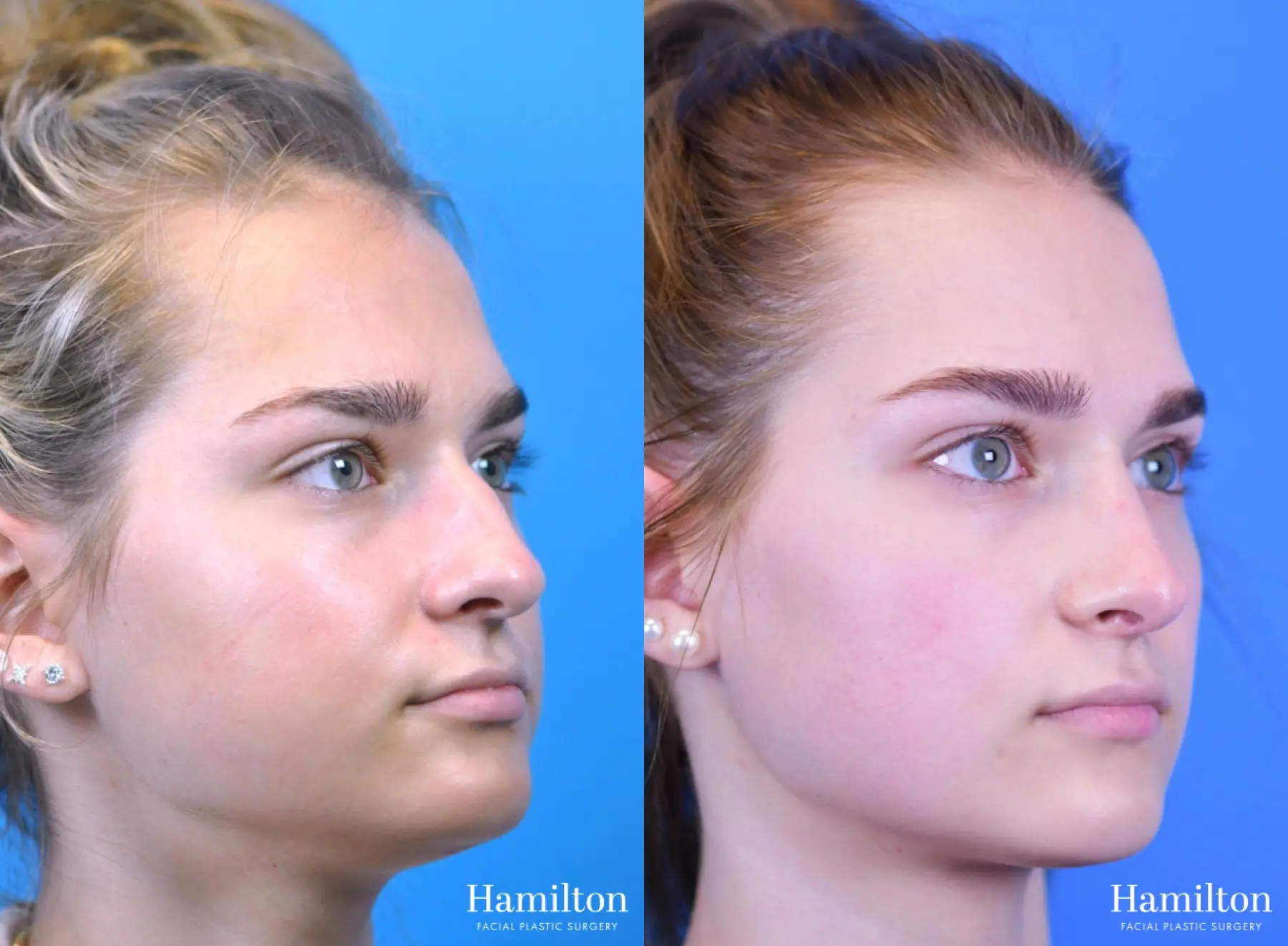 Rhinoplasty: Patient 11 - Before and After 2