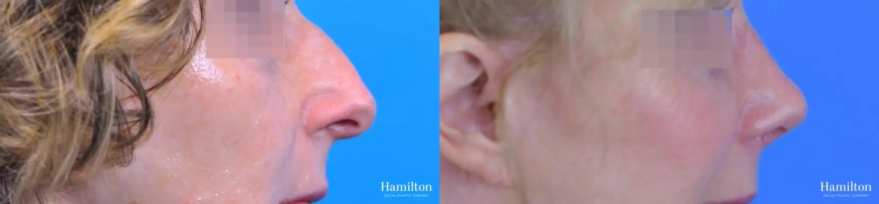 Rhinoplasty: Patient 45 - Before and After 1