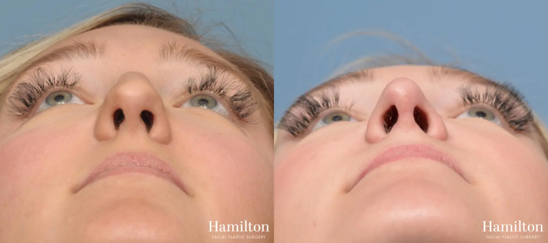 Rhinoplasty: Patient 6 - Before and After 3