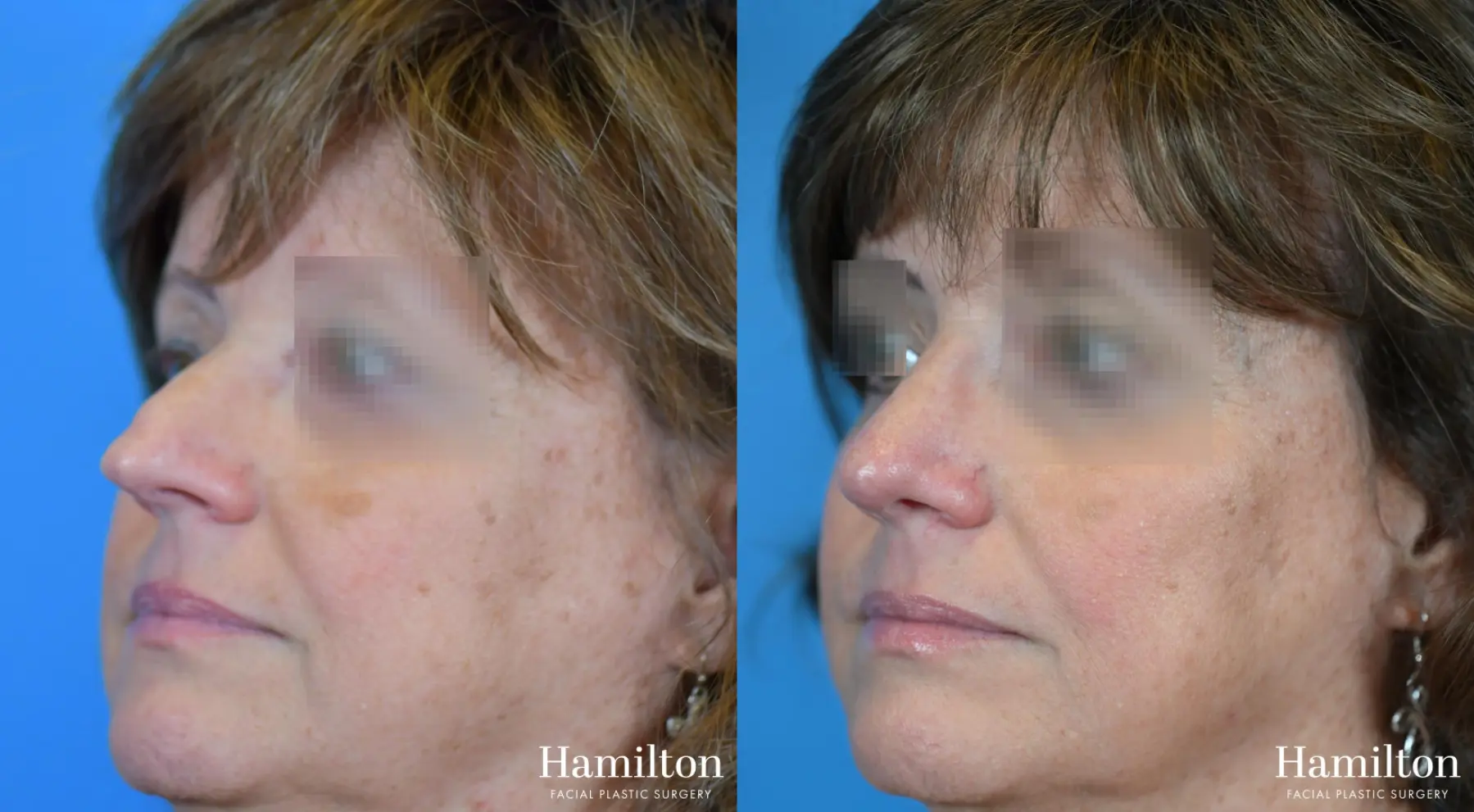 Rhinoplasty: Patient 40 - Before and After 4