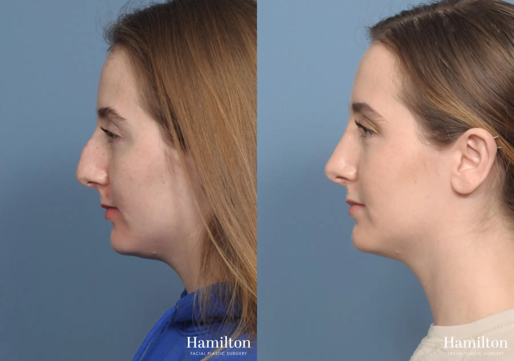 Rhinoplasty: Patient 1 - Before and After 2