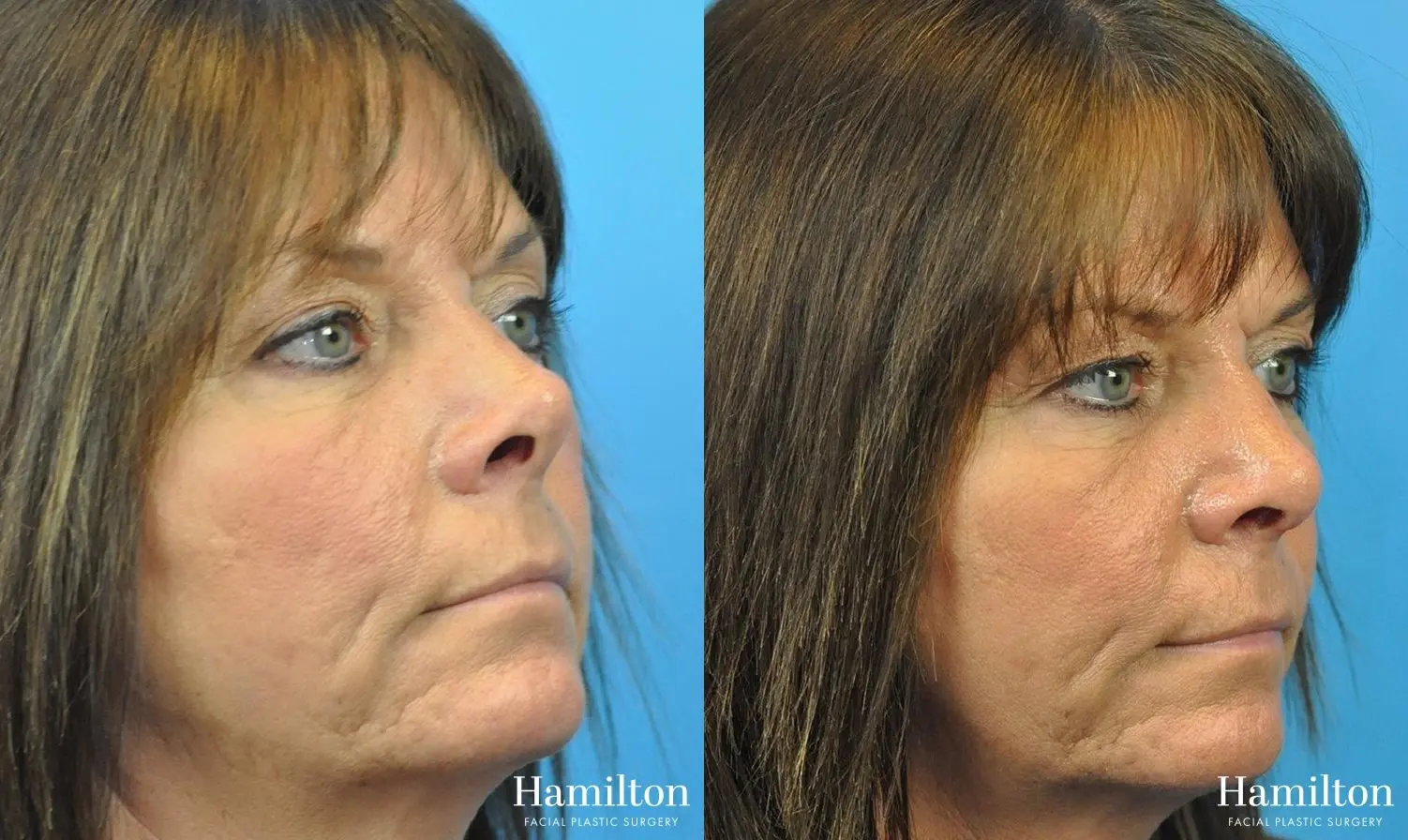 Rhinoplasty: Patient 46 - Before and After 1