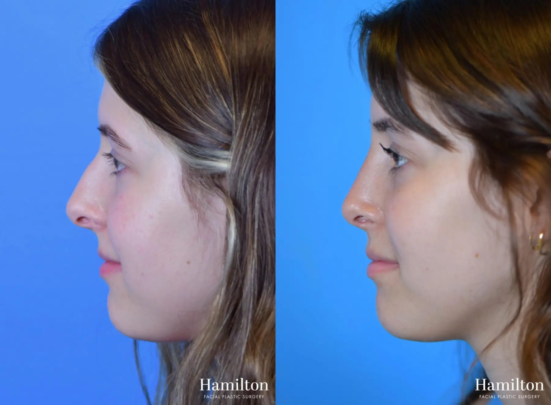 Rhinoplasty: Patient 41 - Before and After 5