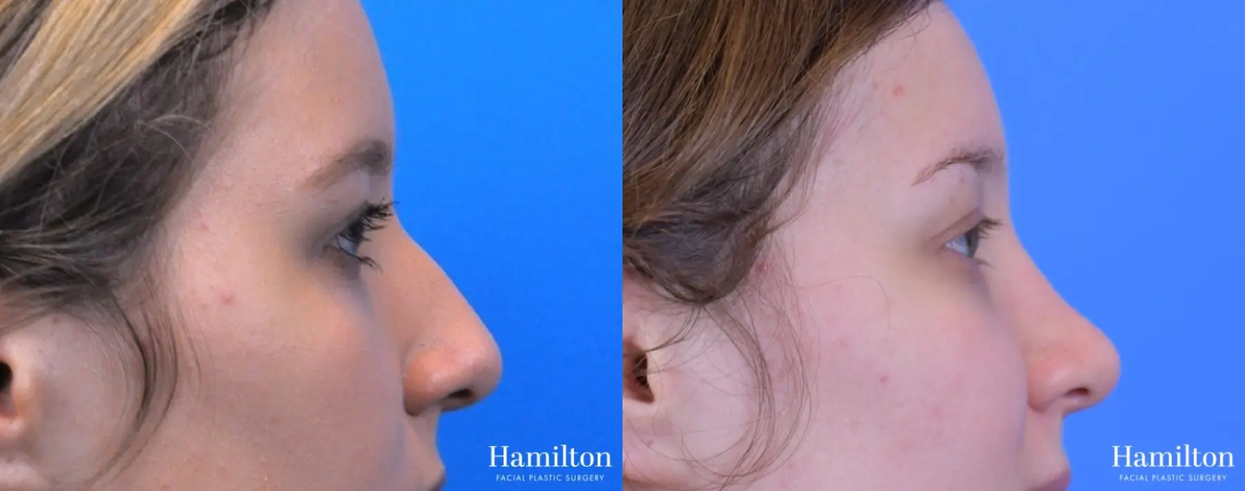 Rhinoplasty: Patient 18 - Before and After 1