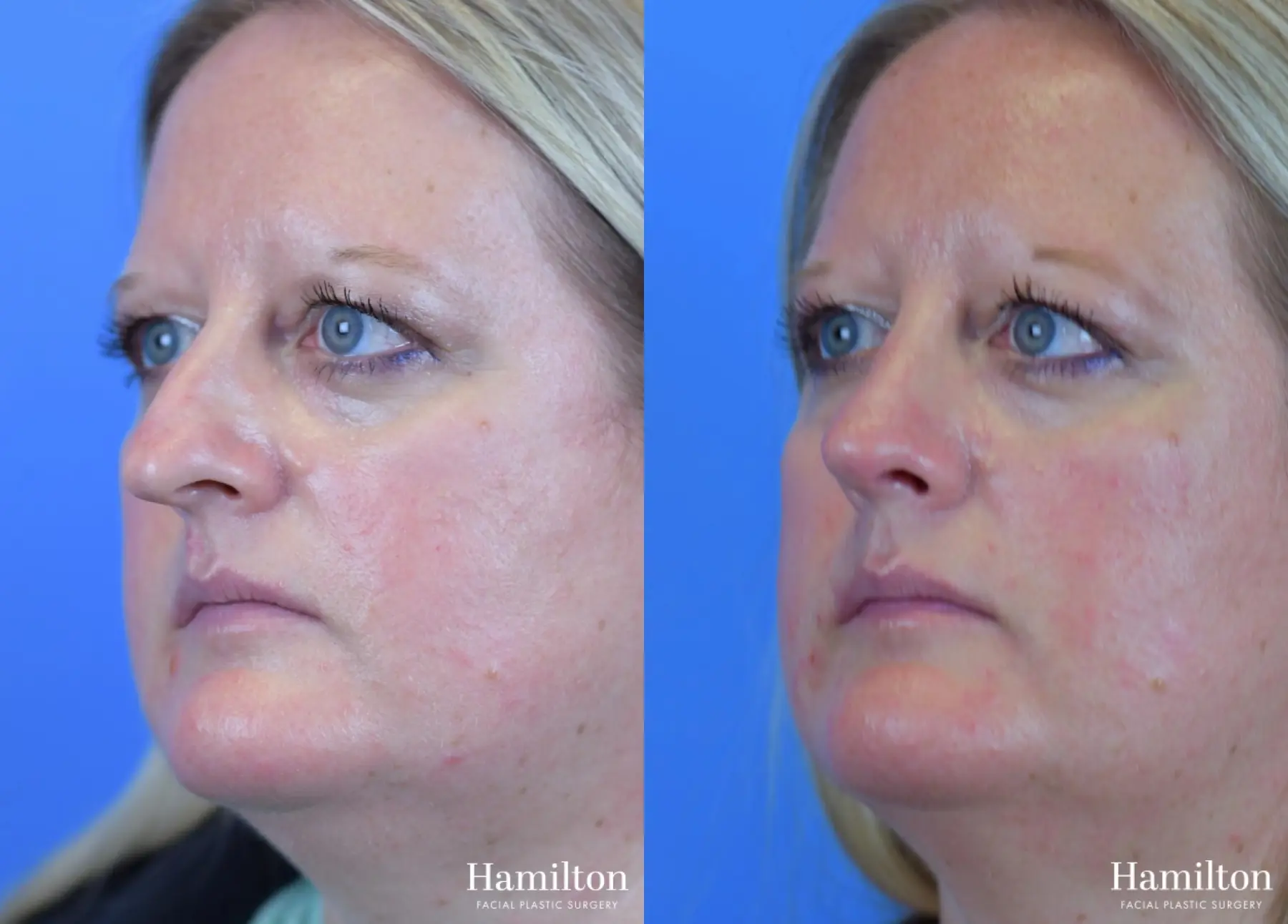 Rhinoplasty: Patient 33 - Before and After 4