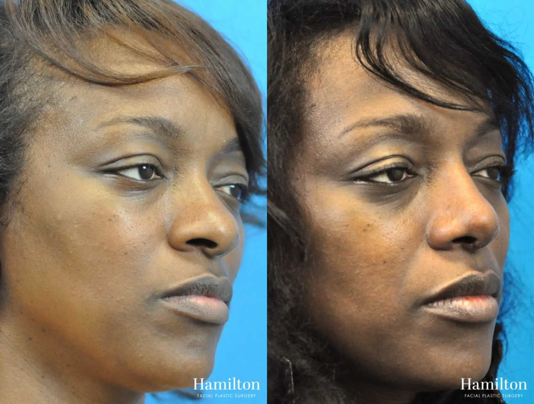 Rhinoplasty: Patient 25 - Before and After 4