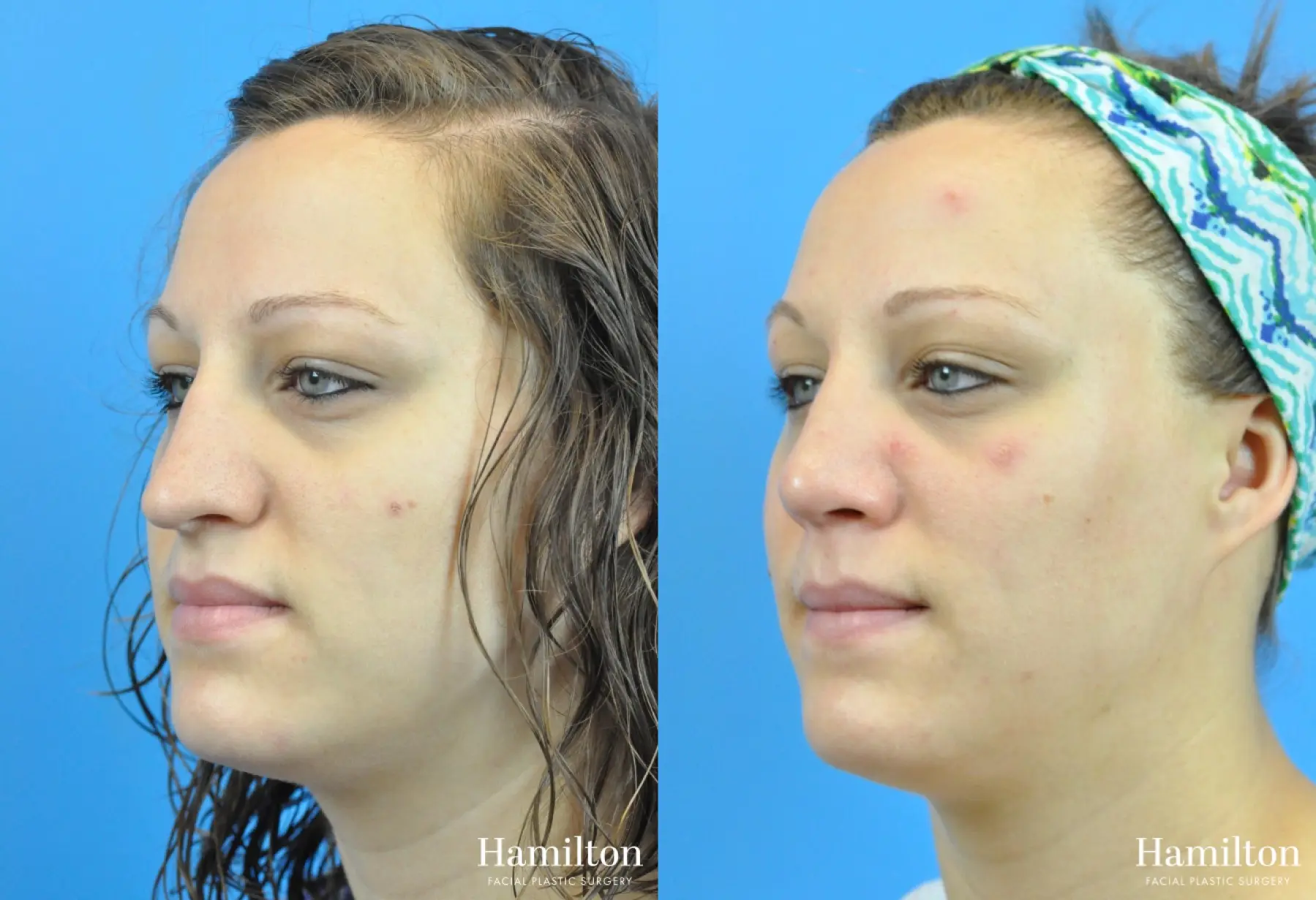 Rhinoplasty: Patient 49 - Before and After 3