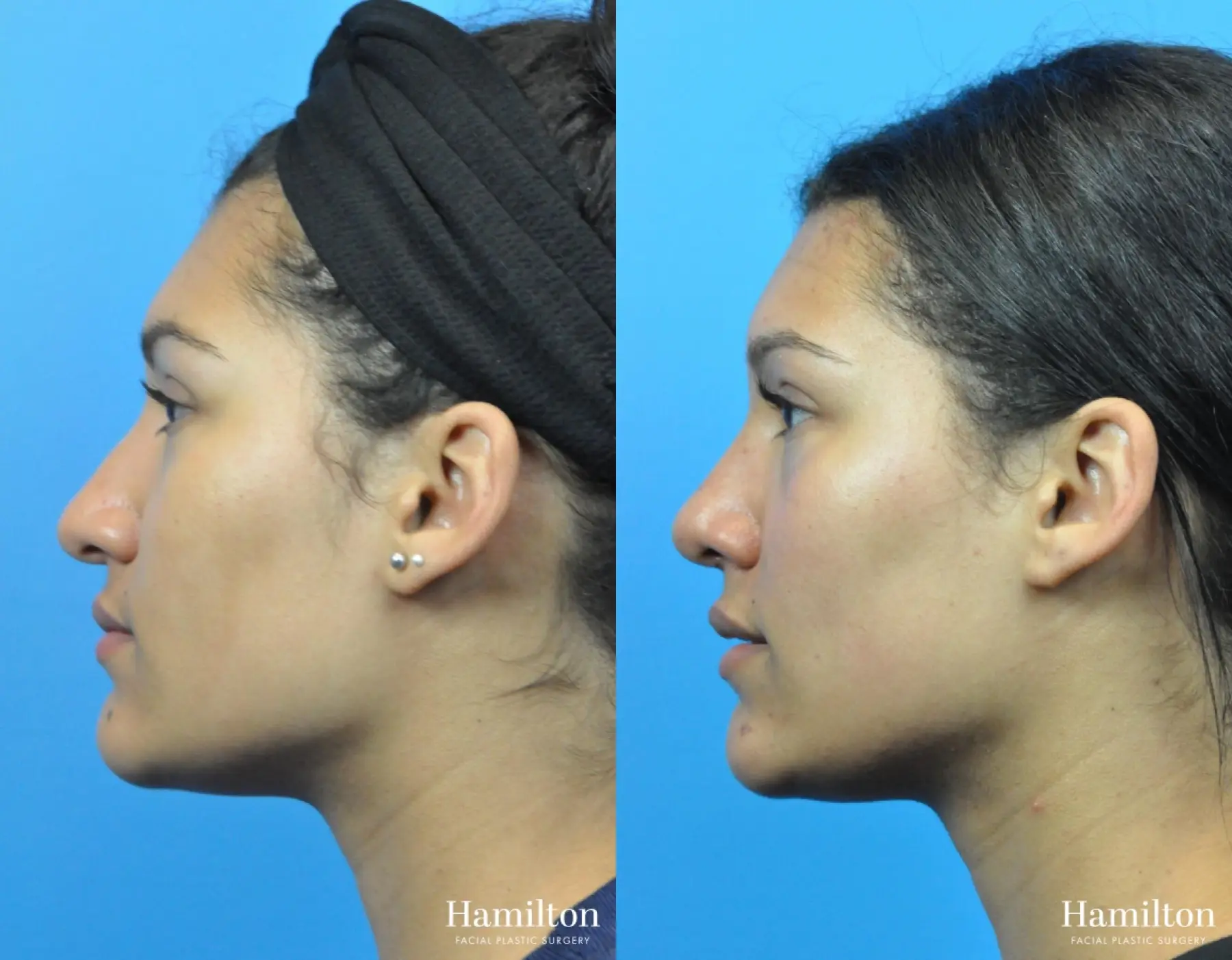 Rhinoplasty: Patient 43 - Before and After 2