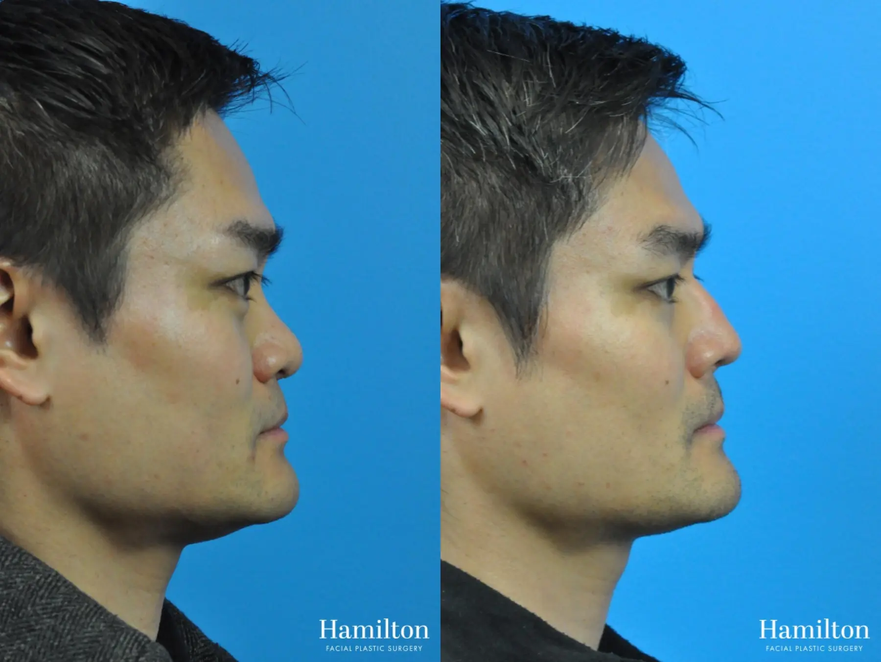 Rhinoplasty: Patient 23 - Before and After 1