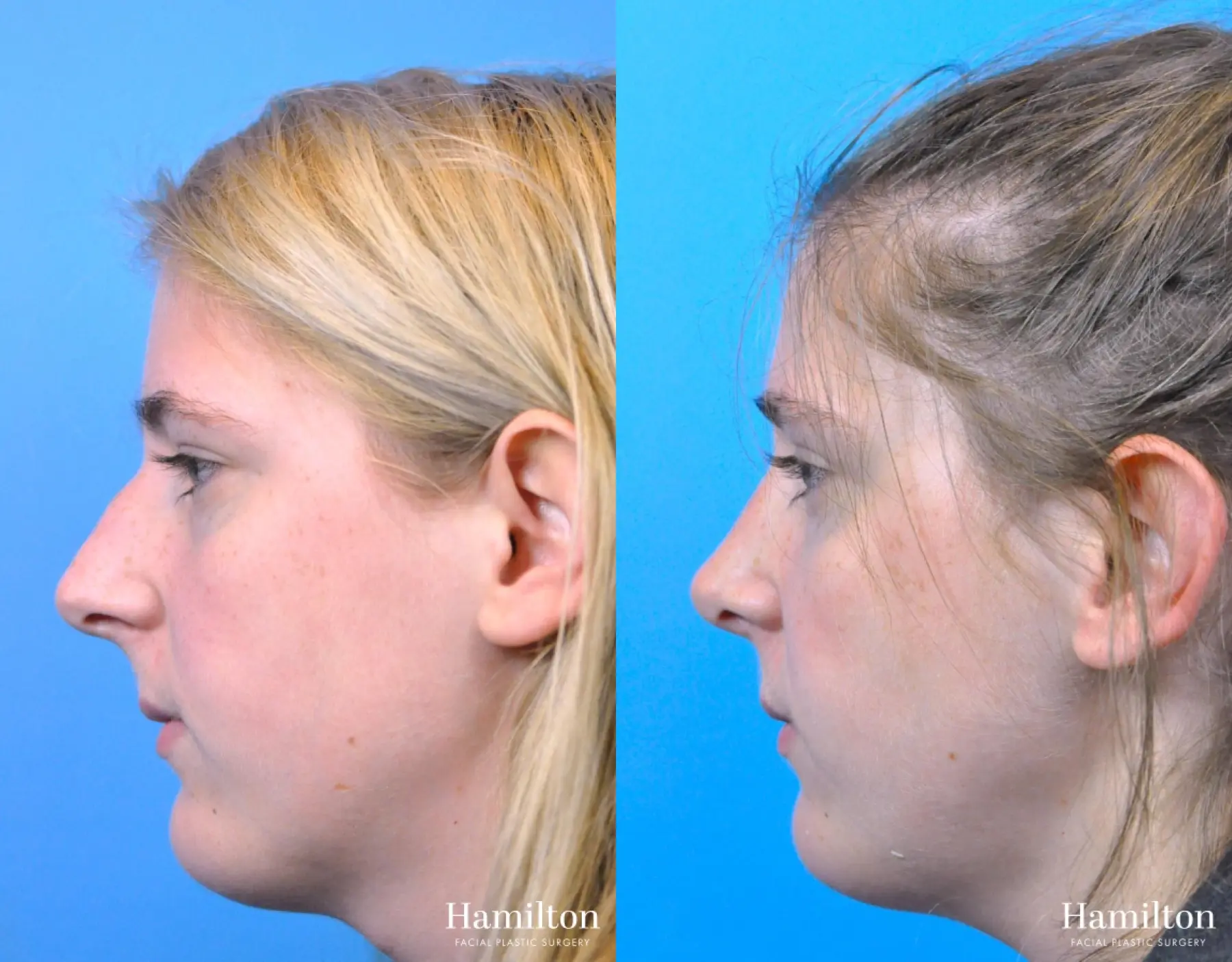 Rhinoplasty: Patient 48 - Before and After 4