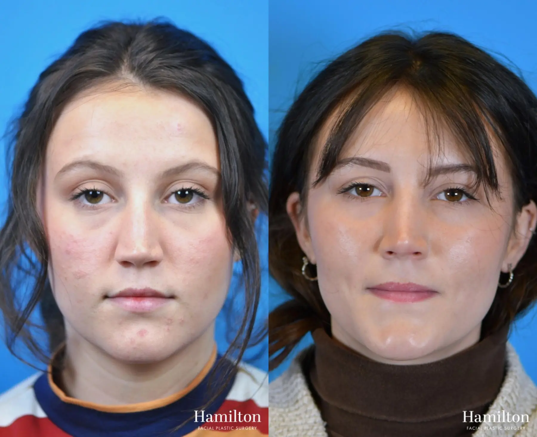 Rhinoplasty: Patient 15 - Before and After 5