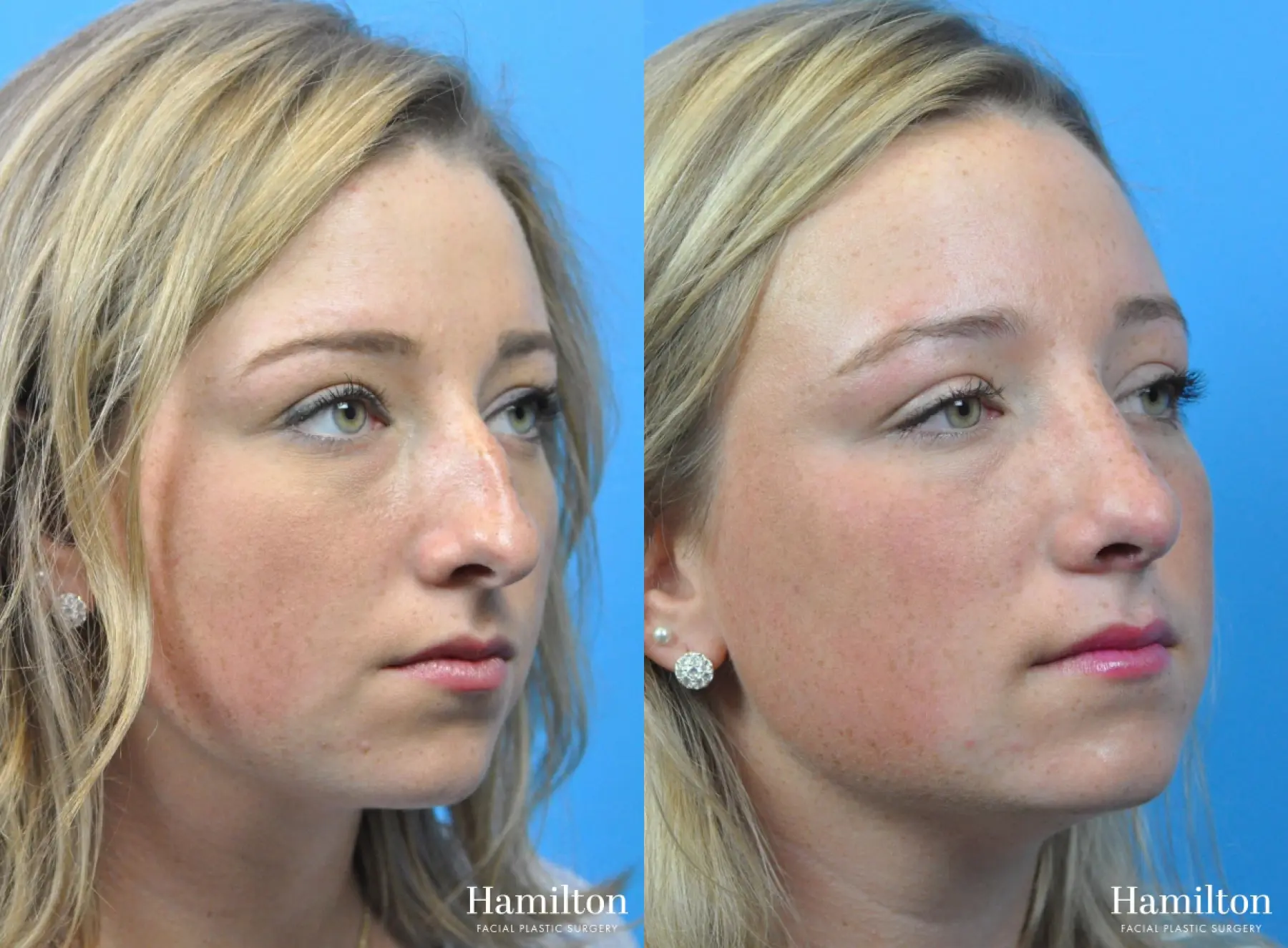 Rhinoplasty: Patient 31 - Before and After 3