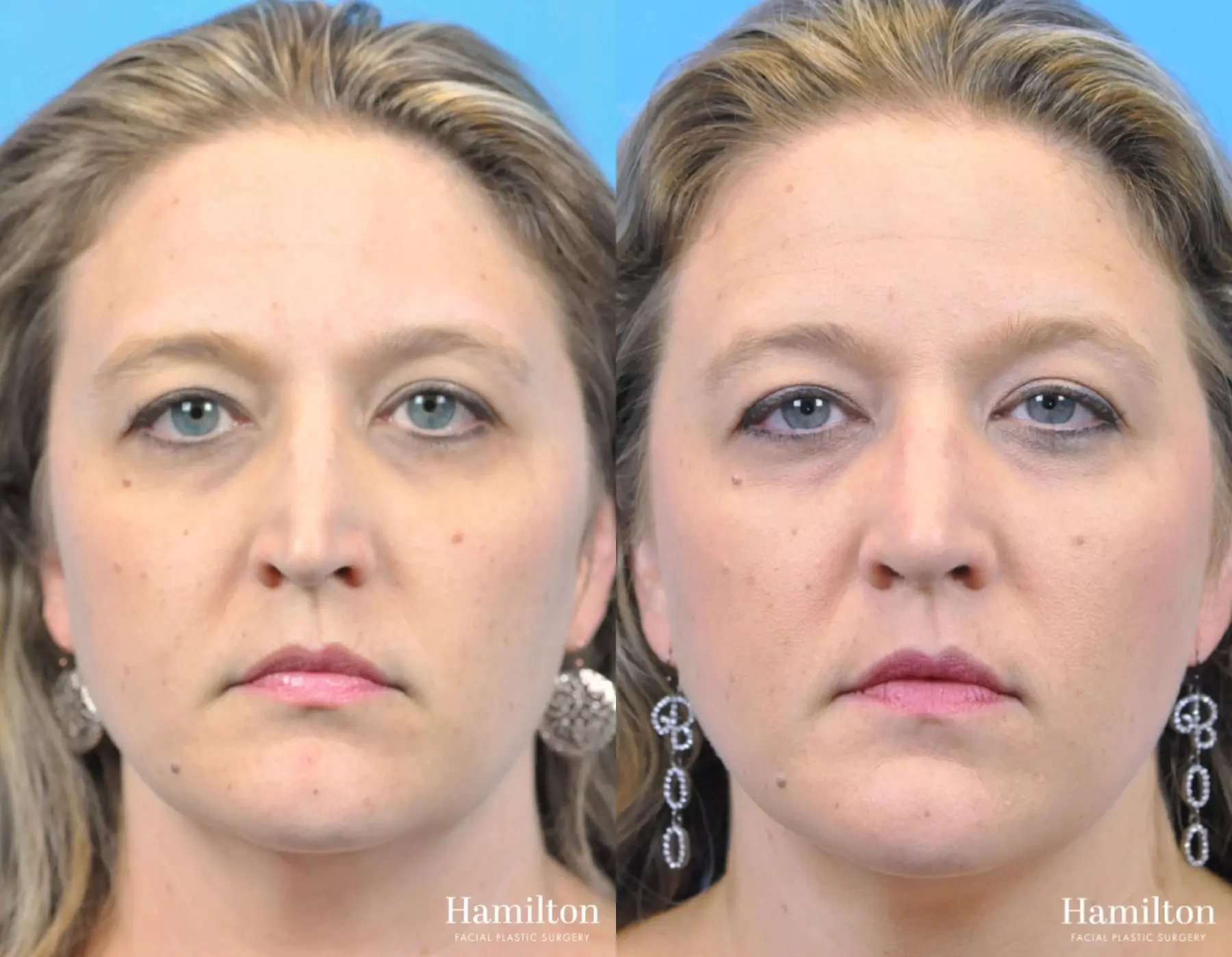 Rhinoplasty: Patient 34 - Before and After 5