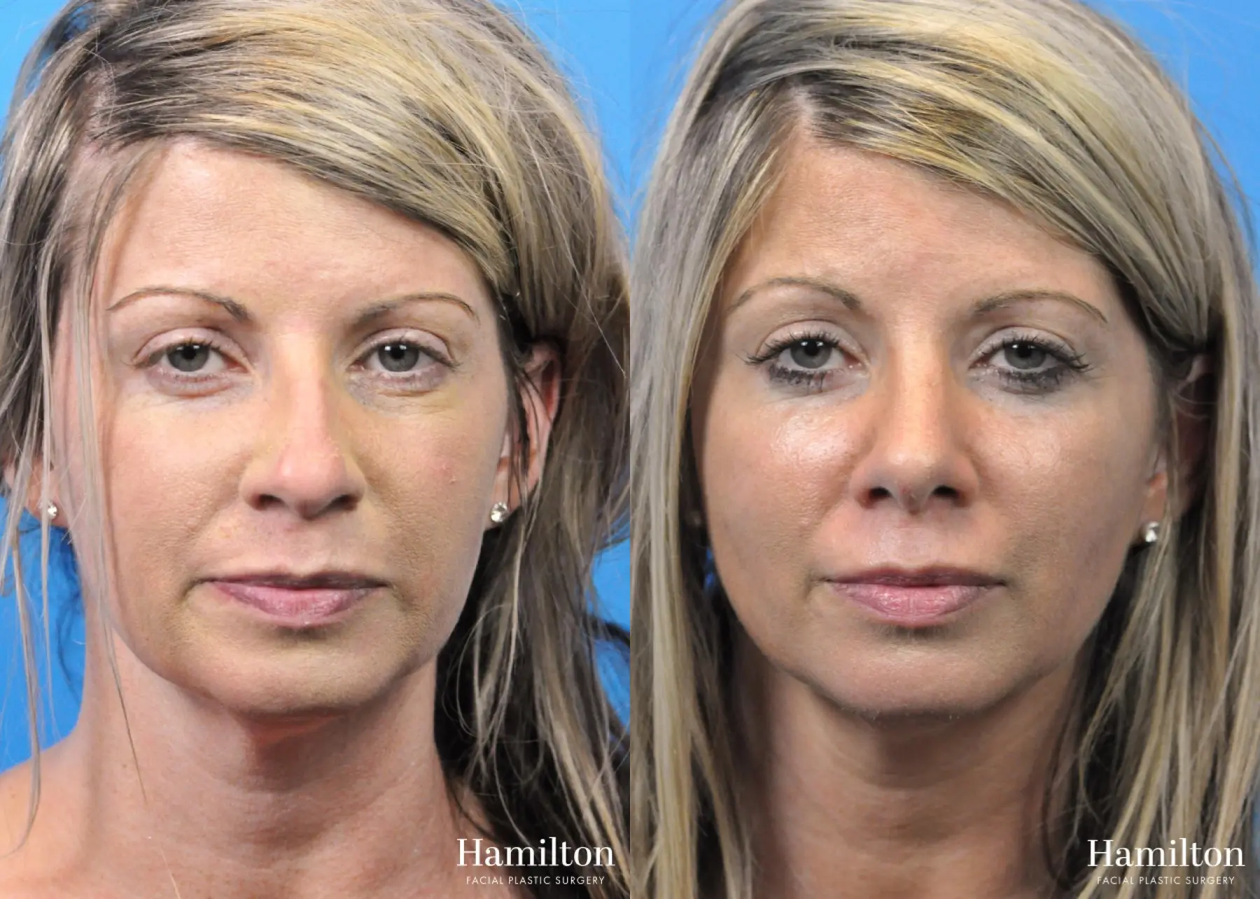 Rhinoplasty: Patient 32 - Before and After 6