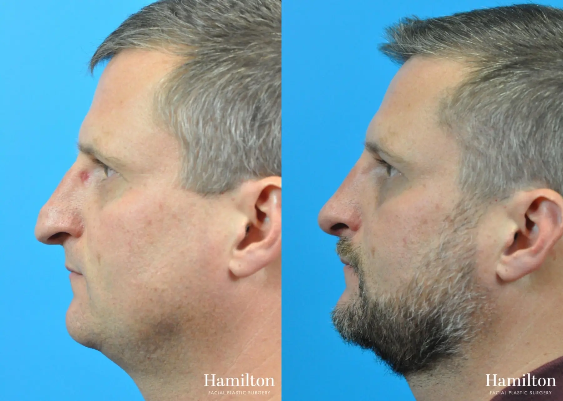 Rhinoplasty: Patient 27 - Before and After 2