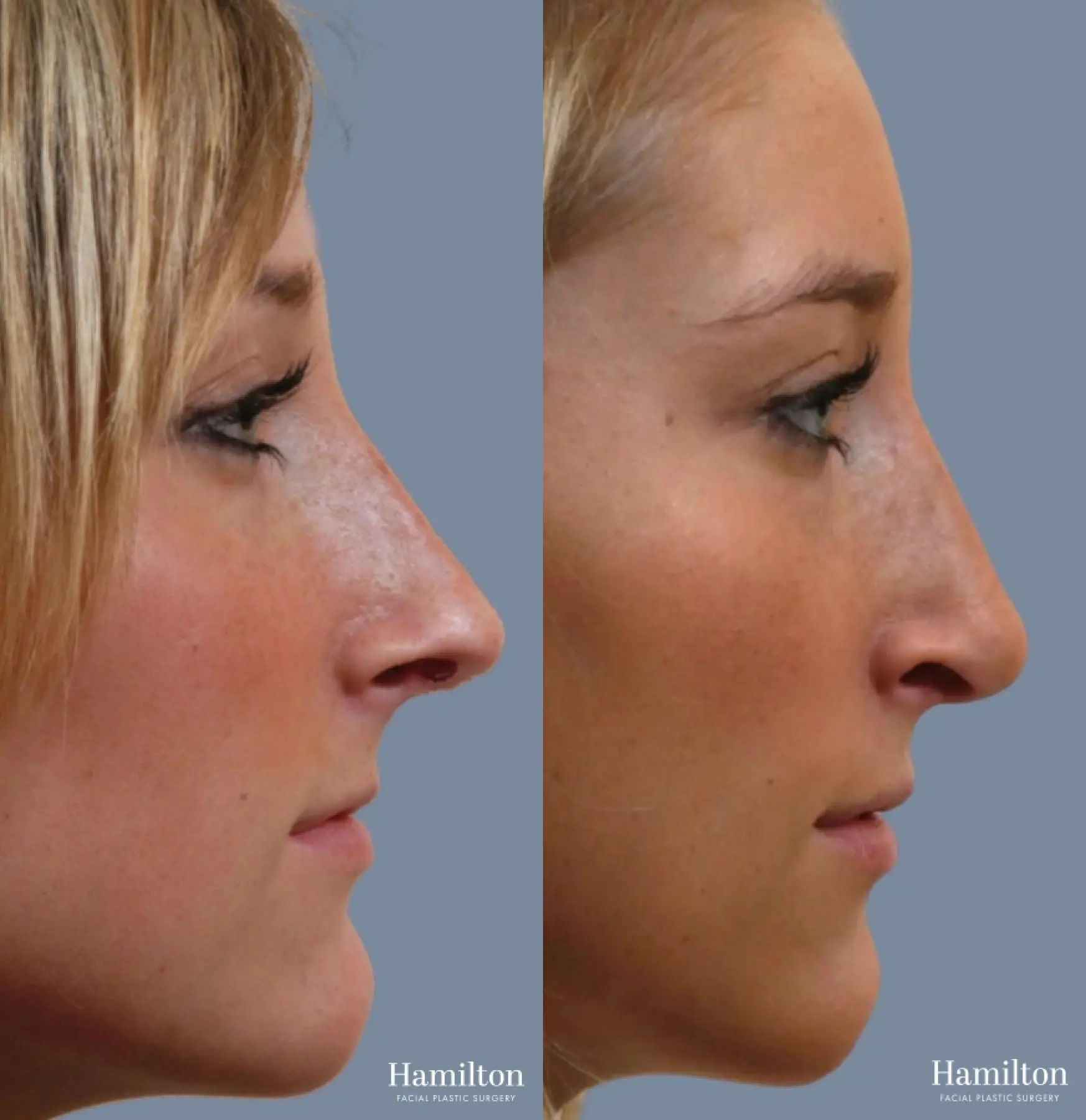 Rhinoplasty: Patient 7 - Before and After 4