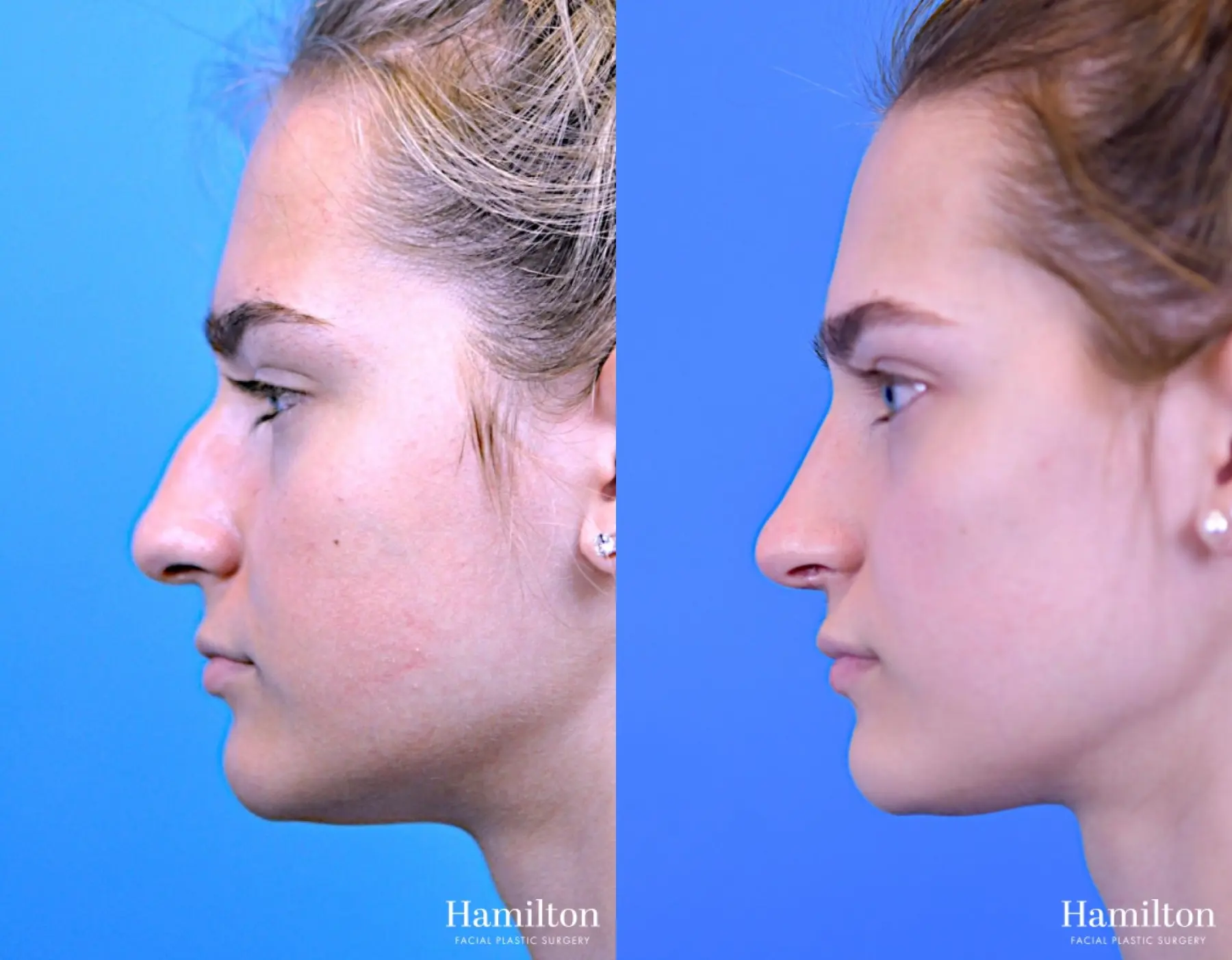 Rhinoplasty: Patient 11 - Before and After 3