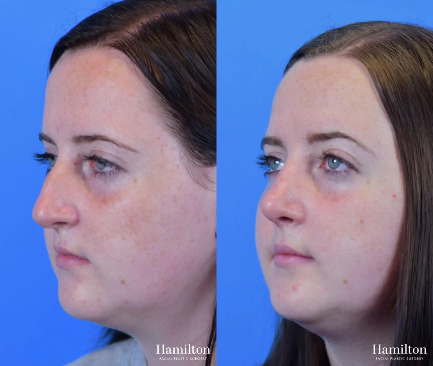 Rhinoplasty: Patient 42 - Before and After 4