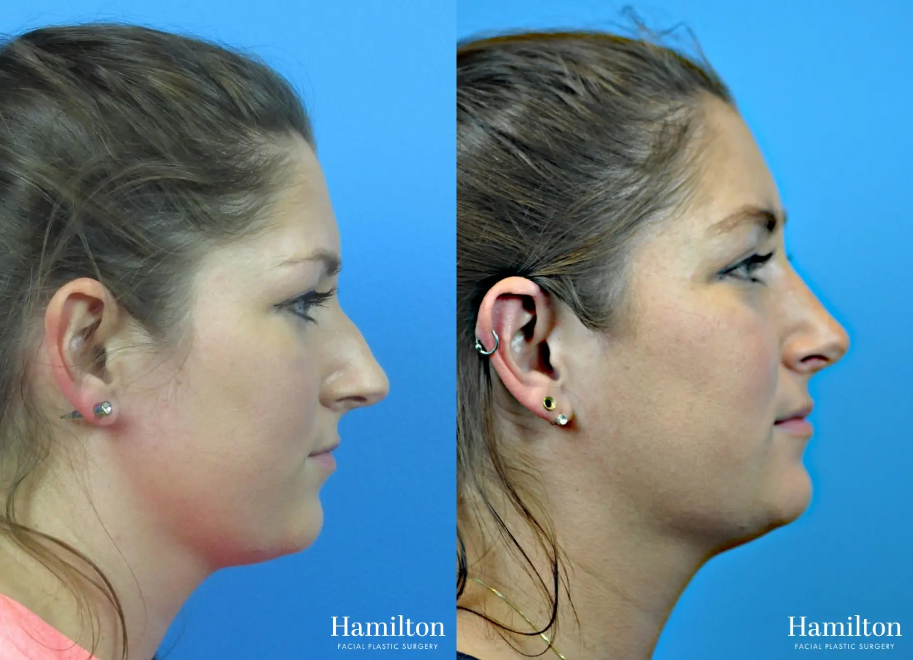 Rhinoplasty: Patient 32 - Before and After 2