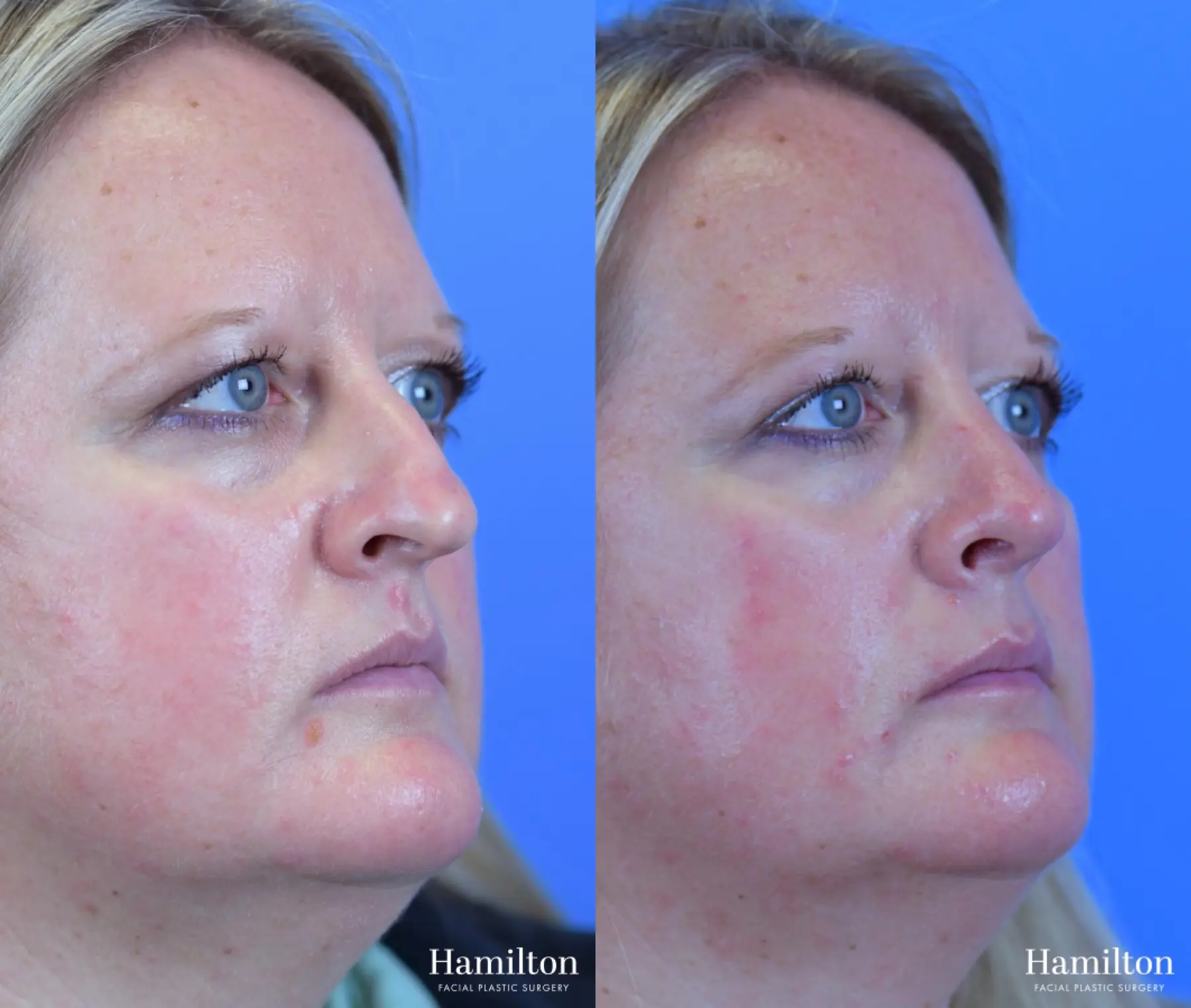 Rhinoplasty: Patient 33 - Before and After 3