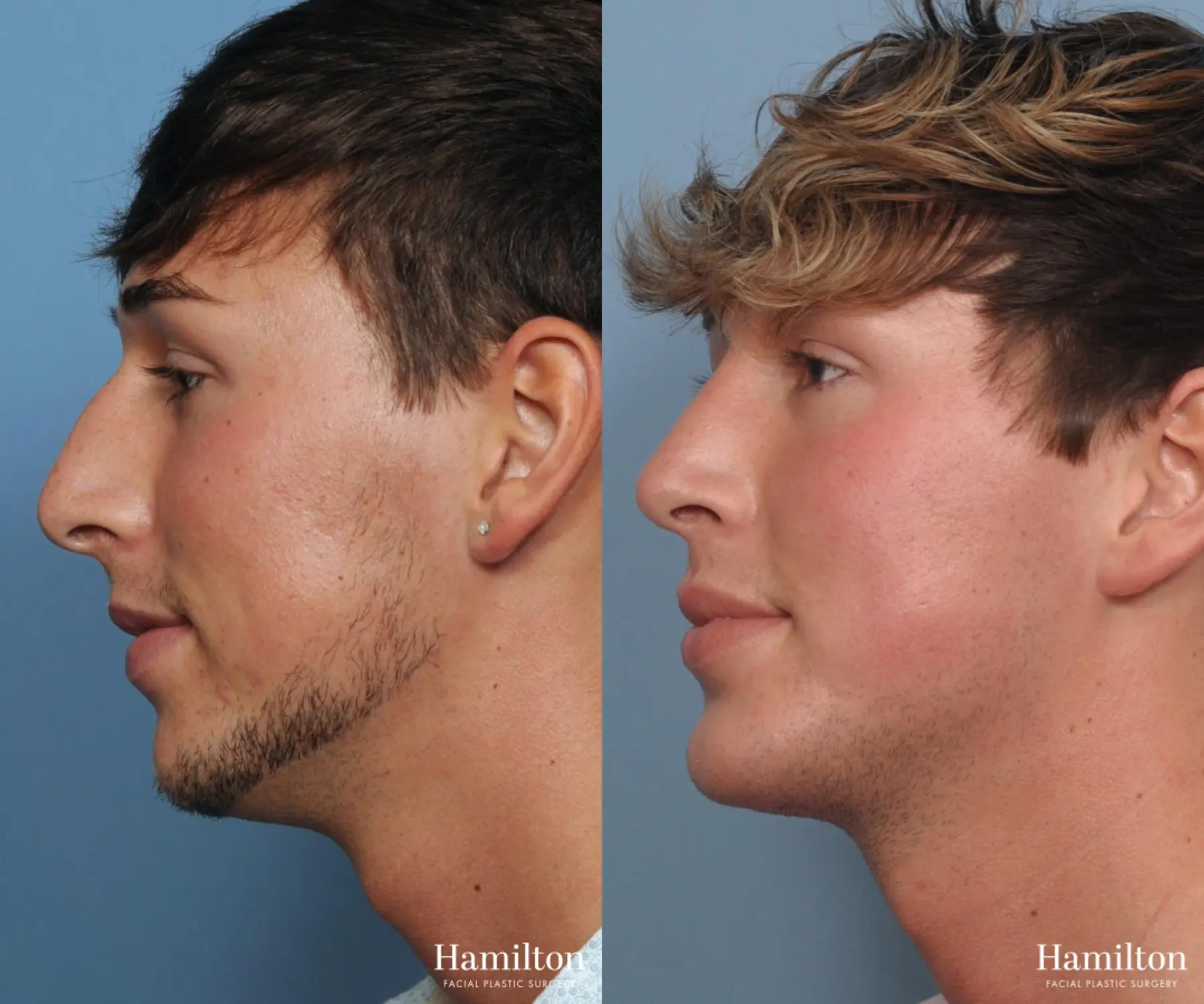 Rhinoplasty: Patient 22 - Before and After 1