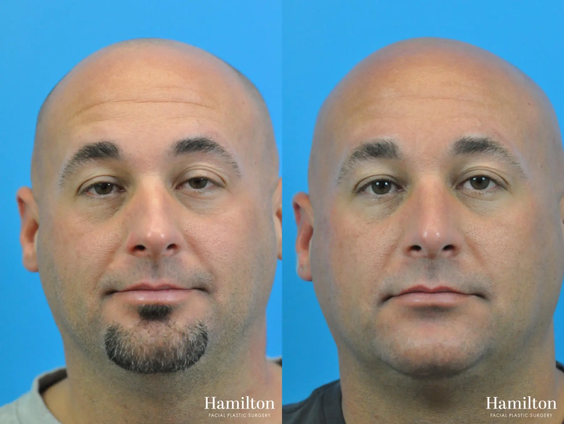 Rhinoplasty: Patient 12 - Before and After 5