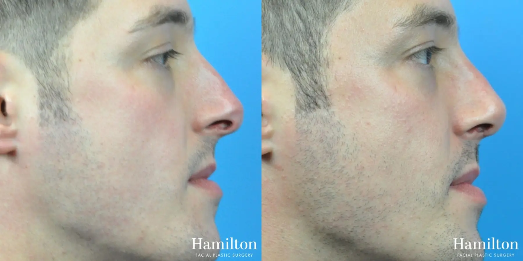 Rhinoplasty: Patient 35 - Before and After 5